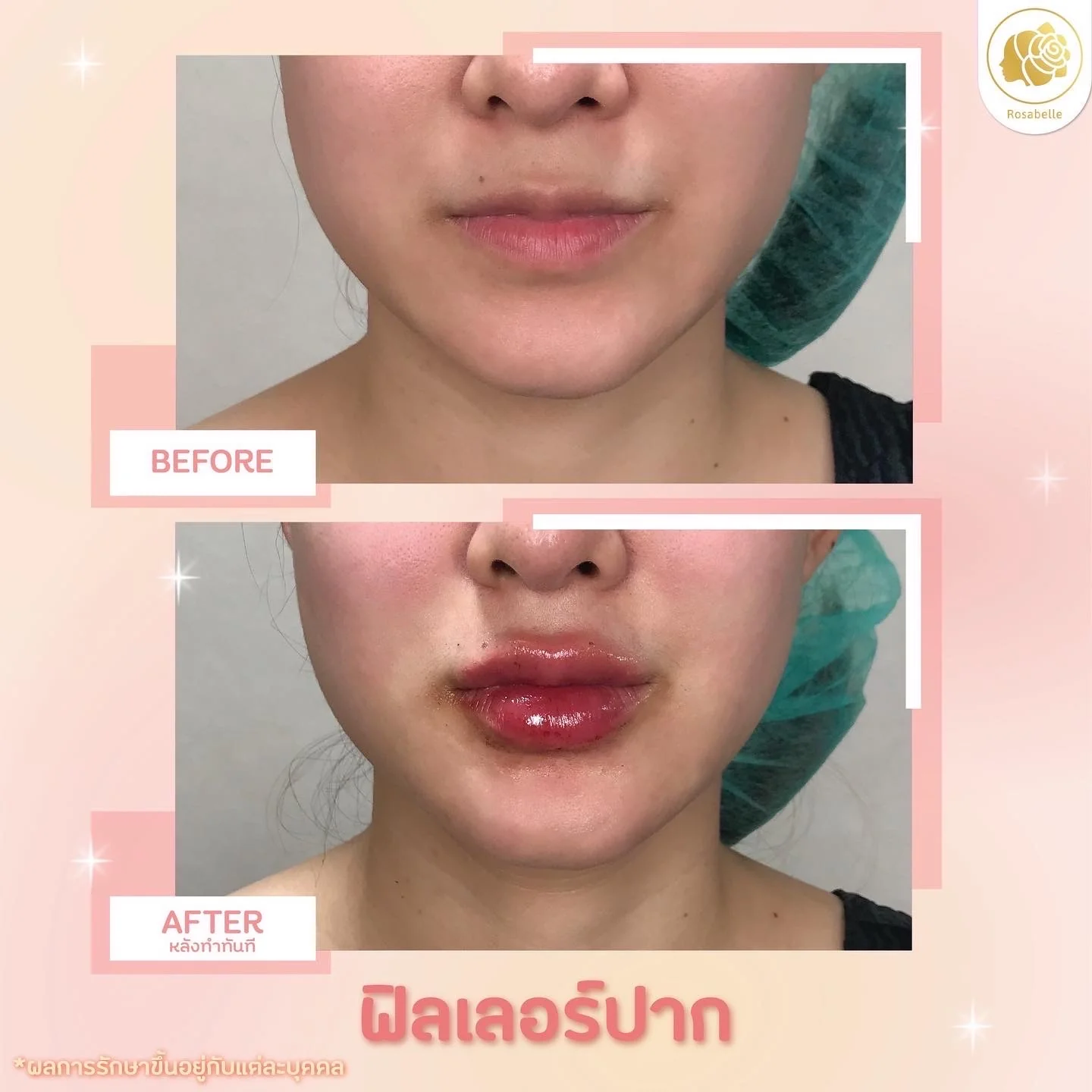ภาพประกอบบทความ Lip filler program: design choices, risks and aftercare
