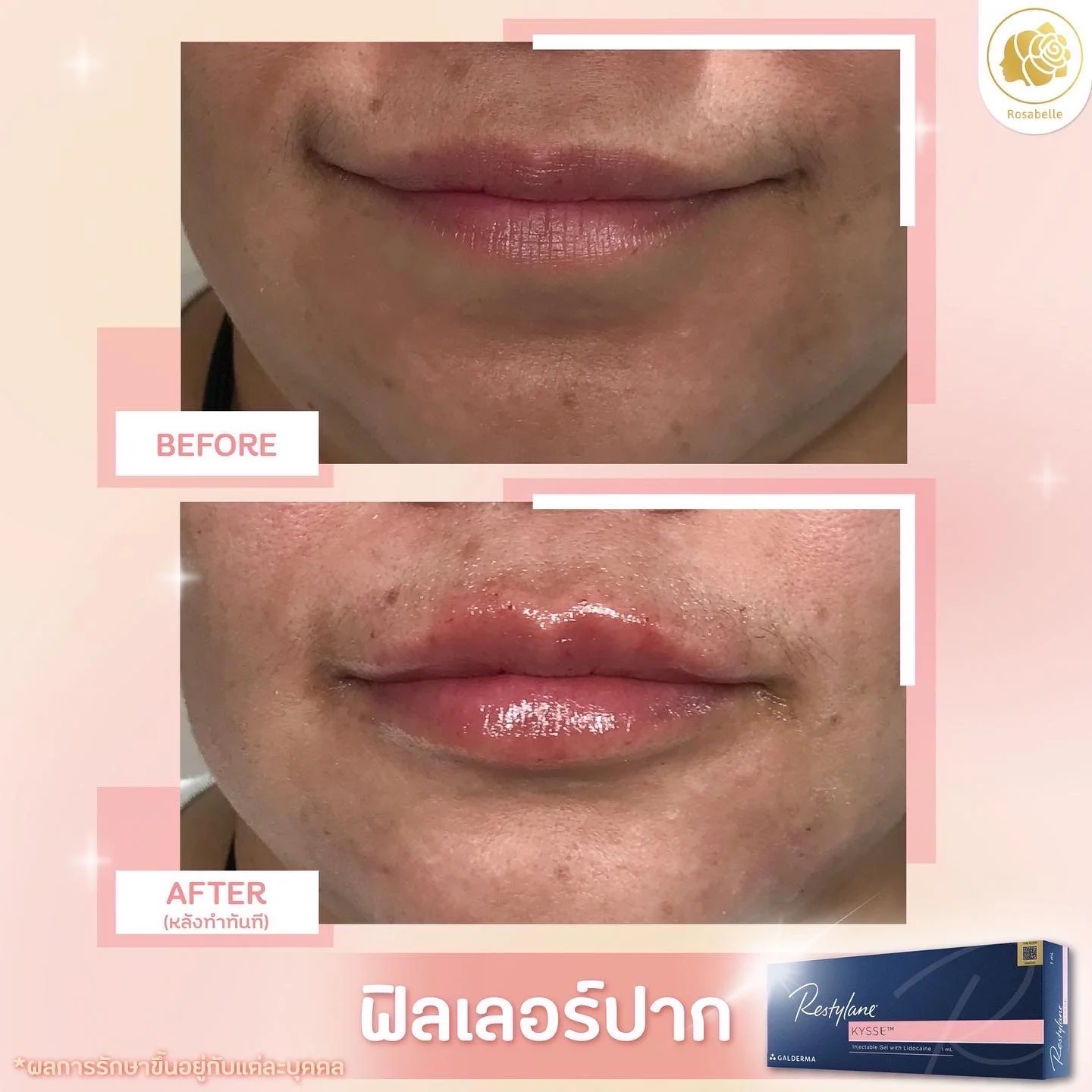 ภาพประกอบบทความ Lip filler program: design choices, risks and aftercare