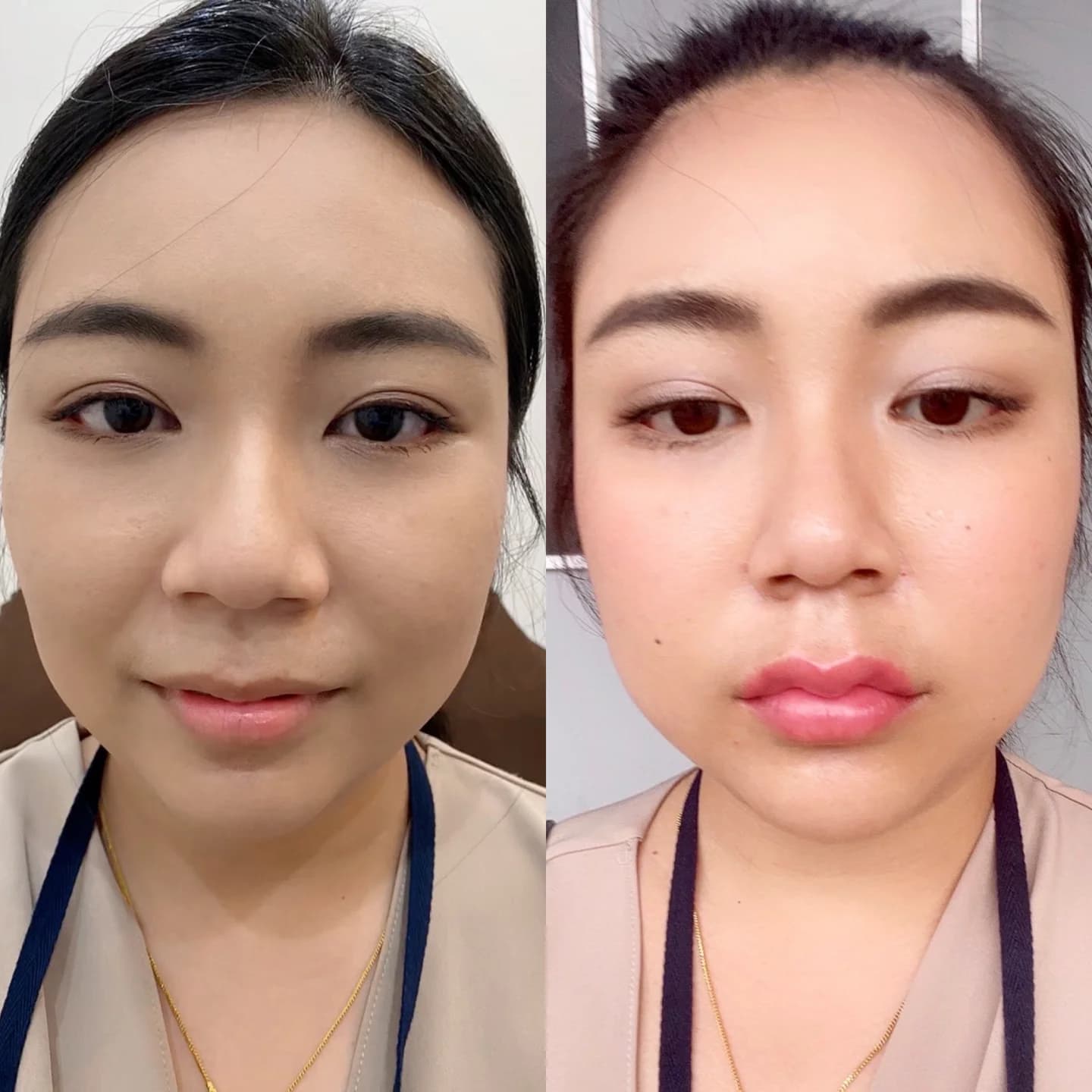 ภาพประกอบบทความ Lip filler program: design choices, risks and aftercare