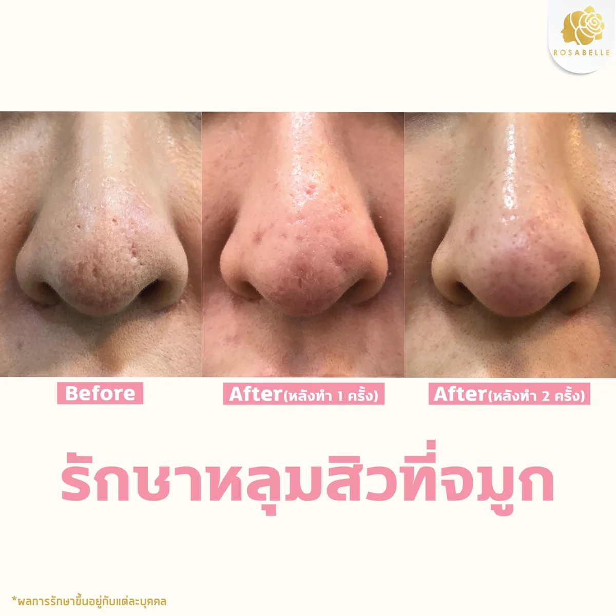 รีวิวรักษาหลุมสิวจมูก ภาพก่อนและหลังทำ ภาพก่อนทำและหลังทำ 1–2 ครั้ง