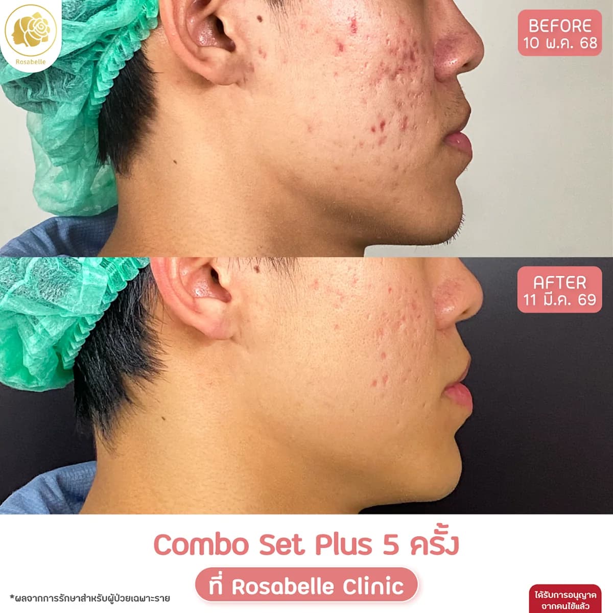 โปรแกรม Combo Set Plus+ ภาพก่อนและหลังทำ หลังทำ 5 ครั้ง