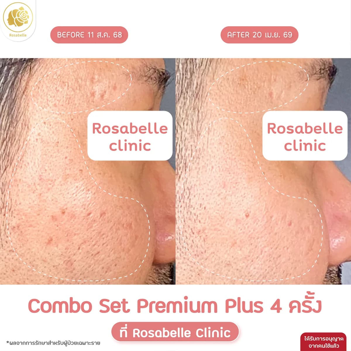 โปรแกรม Combo Set Premium Plus+ ภาพก่อนและหลังทำ หลังทำ 4 ครั้ง
