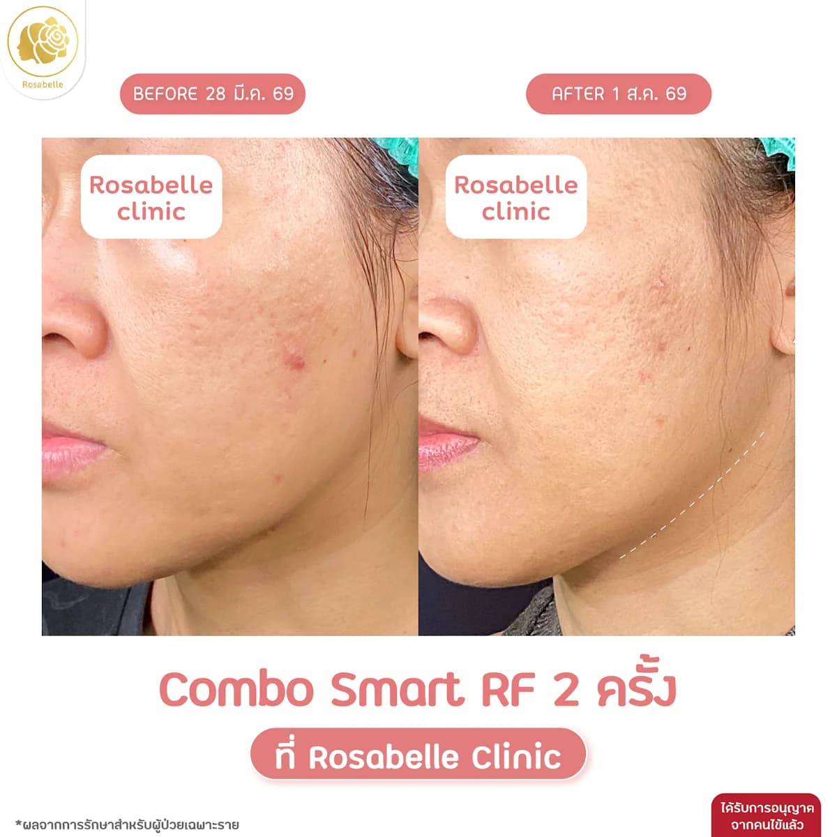 โปรแกรม Combo Smart RF ภาพก่อนและหลังทำ หลังทำ 2 ครั้ง