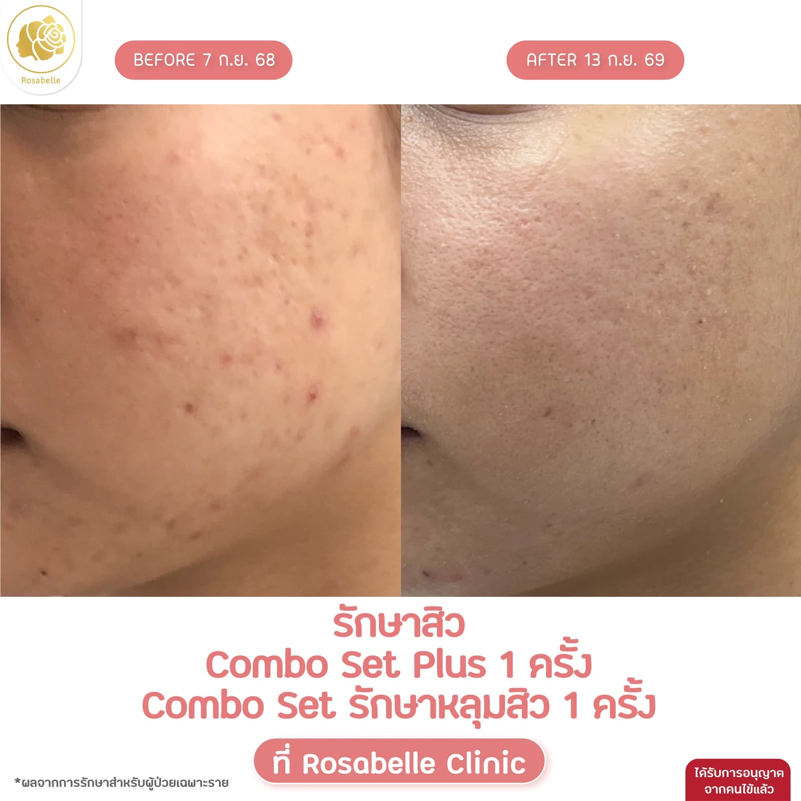 รีวิวรักษาสิวร่วมกับ Combo Set Plus และ Combo Set รักษาหลุมสิว — รักษาสิว ร่วมกับ Combo Set Plus 1 ครั้ง และ Combo Set รักษาหลุมสิว 1 ครั้ง ตามรายละเอียดในภาพ