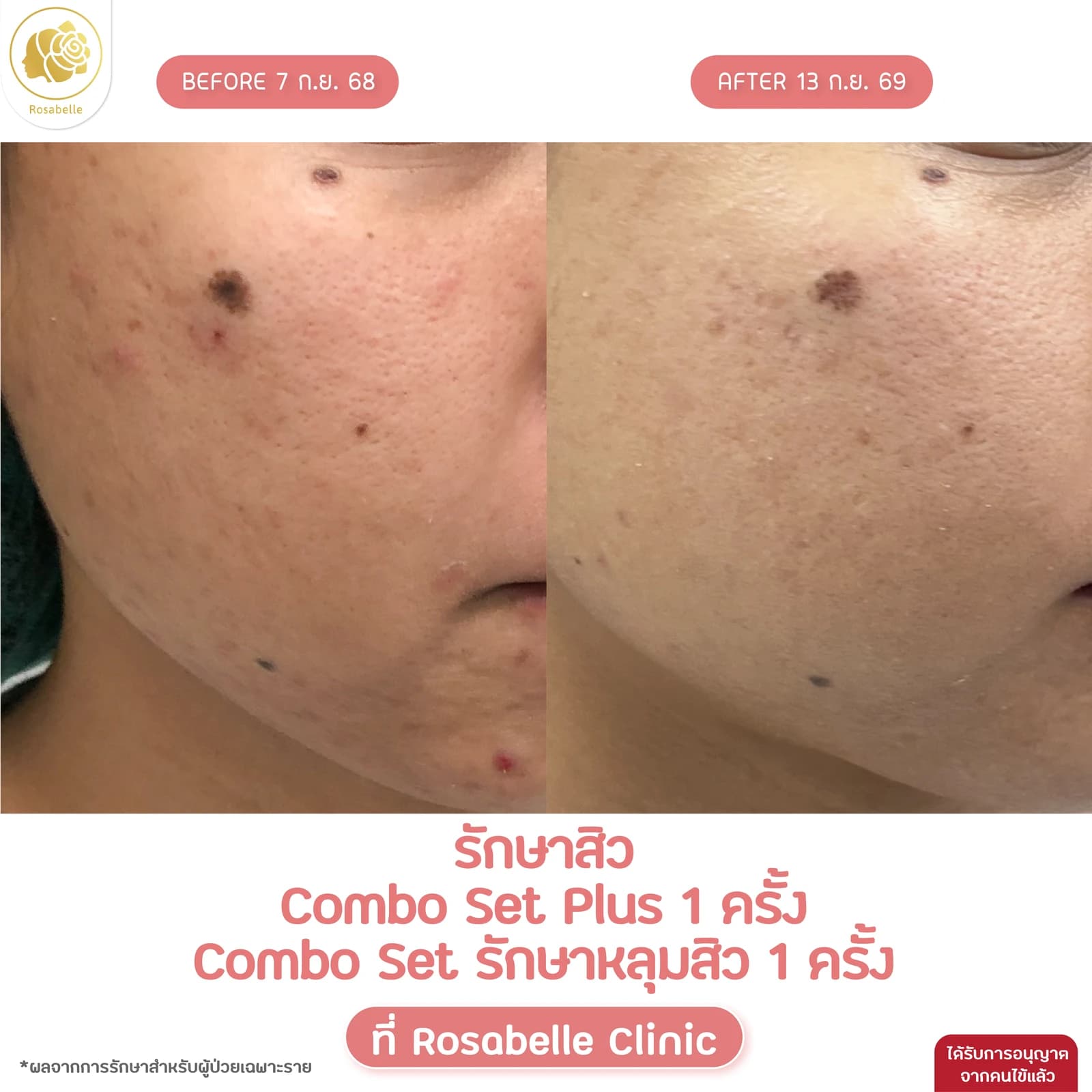 รีวิวรักษาสิวร่วมกับ Combo Set Plus และ Combo Set รักษาหลุมสิว — รักษาสิว ร่วมกับ Combo Set Plus 1 ครั้ง และ Combo Set รักษาหลุมสิว 1 ครั้ง ตามรายละเอียดในภาพ