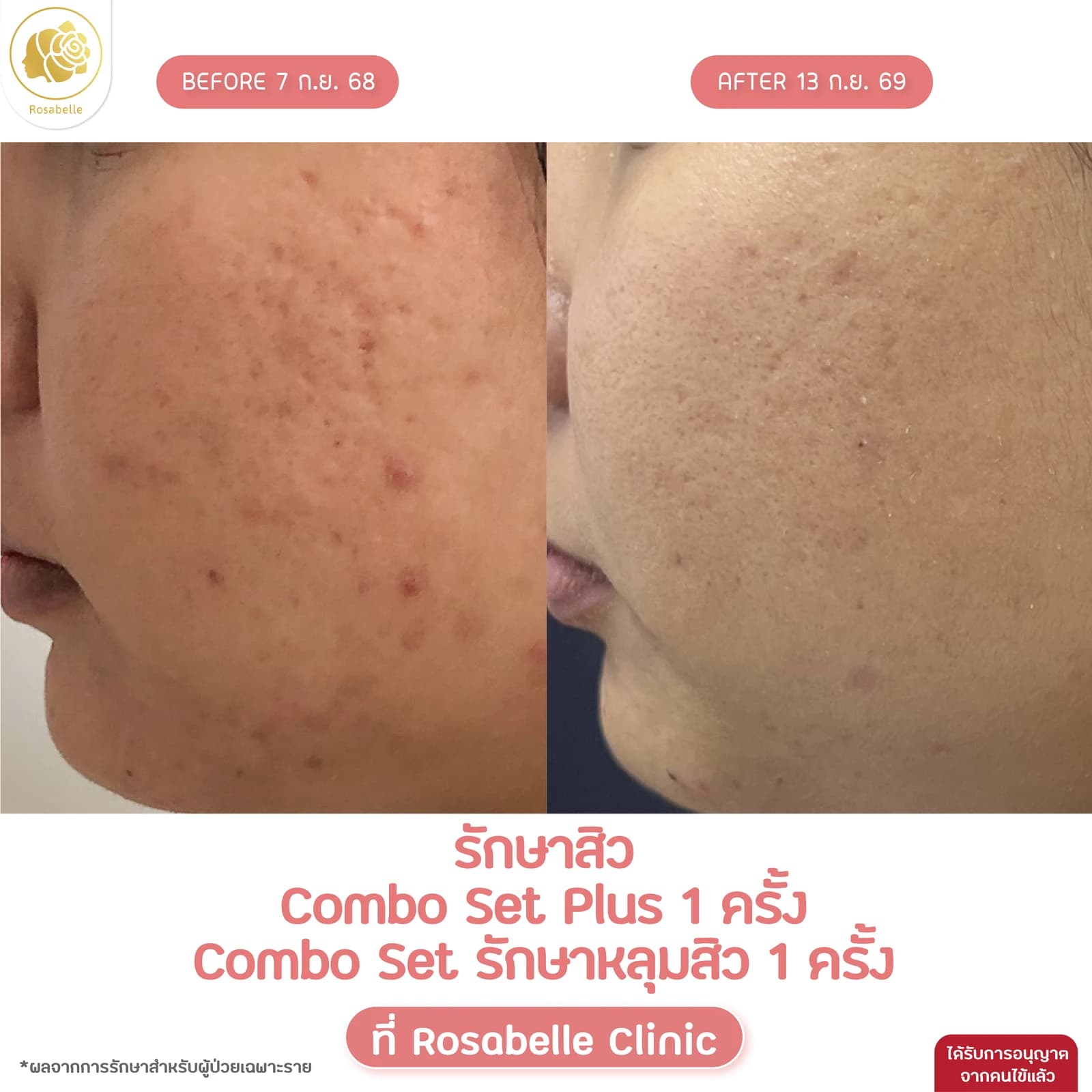 รีวิวรักษาสิวร่วมกับ Combo Set Plus และ Combo Set รักษาหลุมสิว — รักษาสิว ร่วมกับ Combo Set Plus 1 ครั้ง และ Combo Set รักษาหลุมสิว 1 ครั้ง ตามรายละเอียดในภาพ