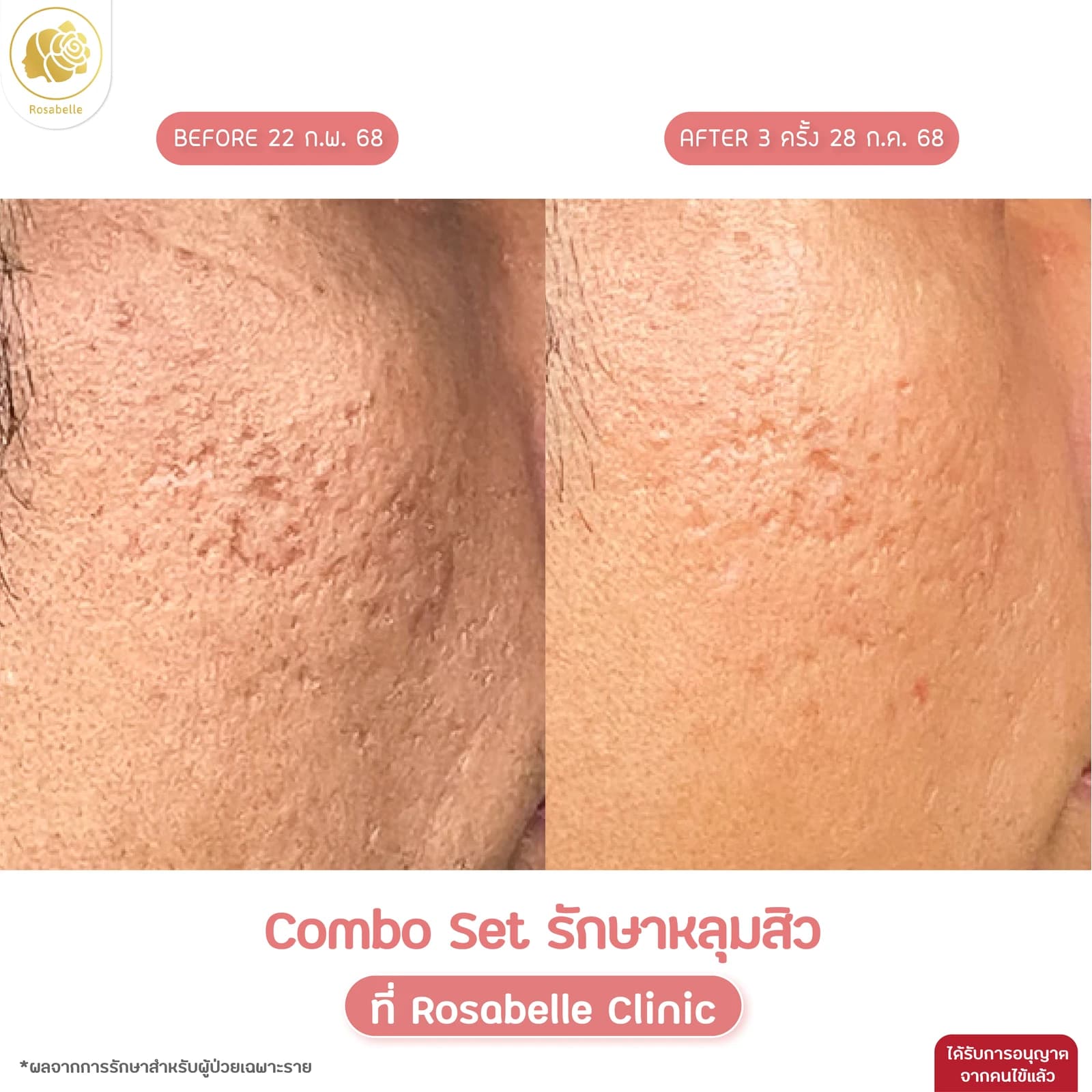 รีวิวโปรแกรม Combo Set รักษาหลุมสิว — ภาพก่อนทำและหลังทำ 3 ครั้ง ตามรายละเอียดในภาพ