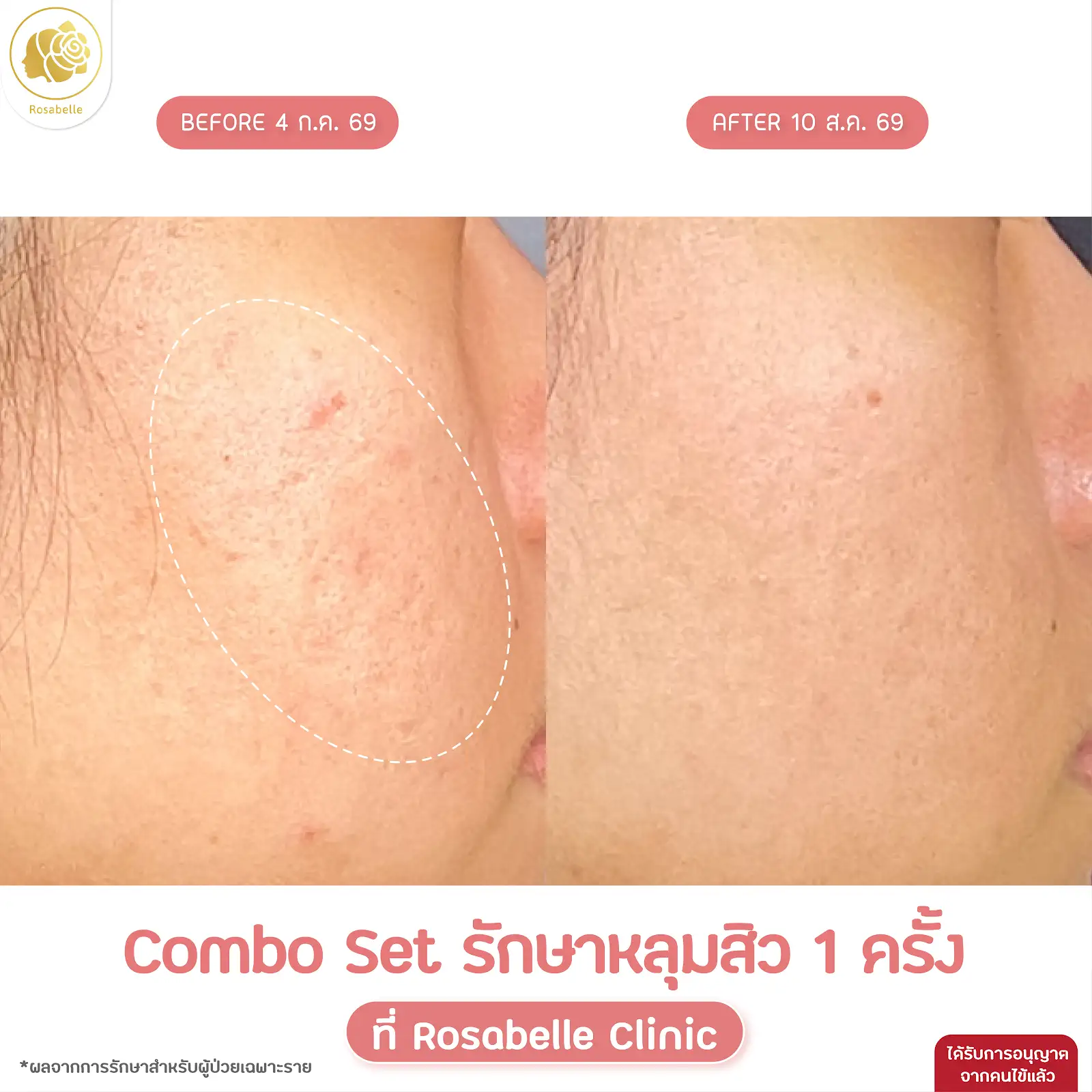 รีวิวโปรแกรม Combo Set — ดูช่วงเวลาและจำนวนครั้งที่ระบุในภาพ