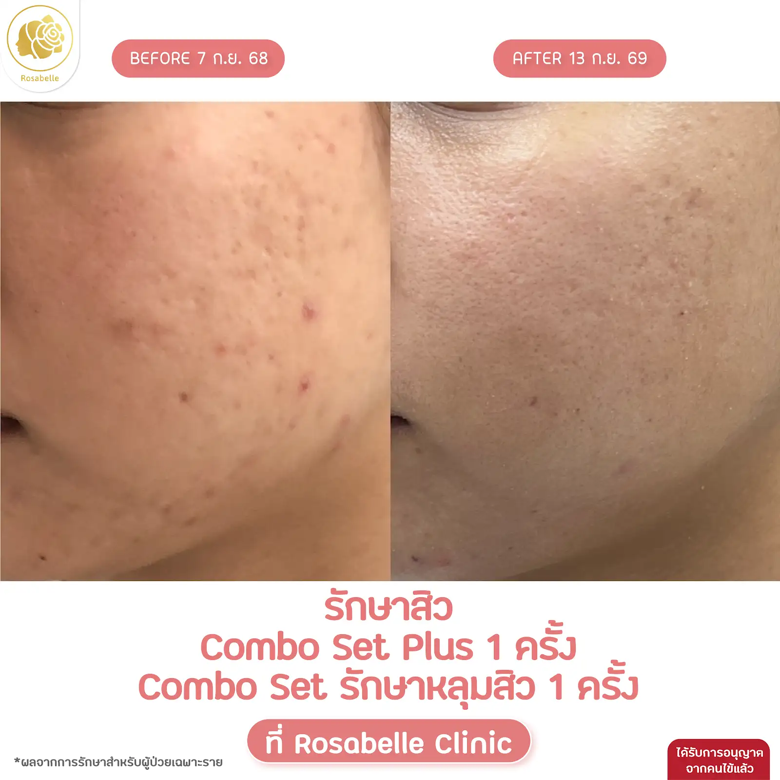 รีวิวดูแลสิวร่วมกับโปรแกรม Combo Set และ Plus+ — ภาพการรักษาหลายโปรแกรมร่วมกัน ตามรายละเอียดในภาพ