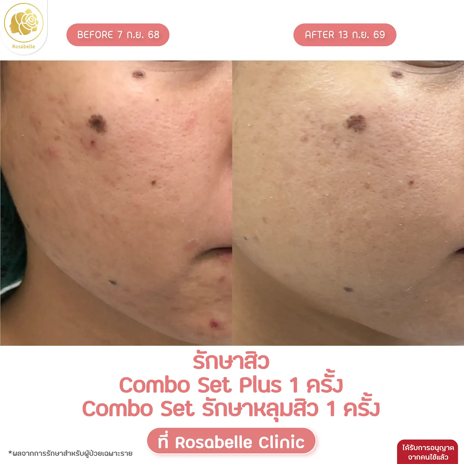 รีวิวดูแลสิวร่วมกับโปรแกรม Combo Set และ Plus+ — ภาพการรักษาหลายโปรแกรมร่วมกัน ตามรายละเอียดในภาพ