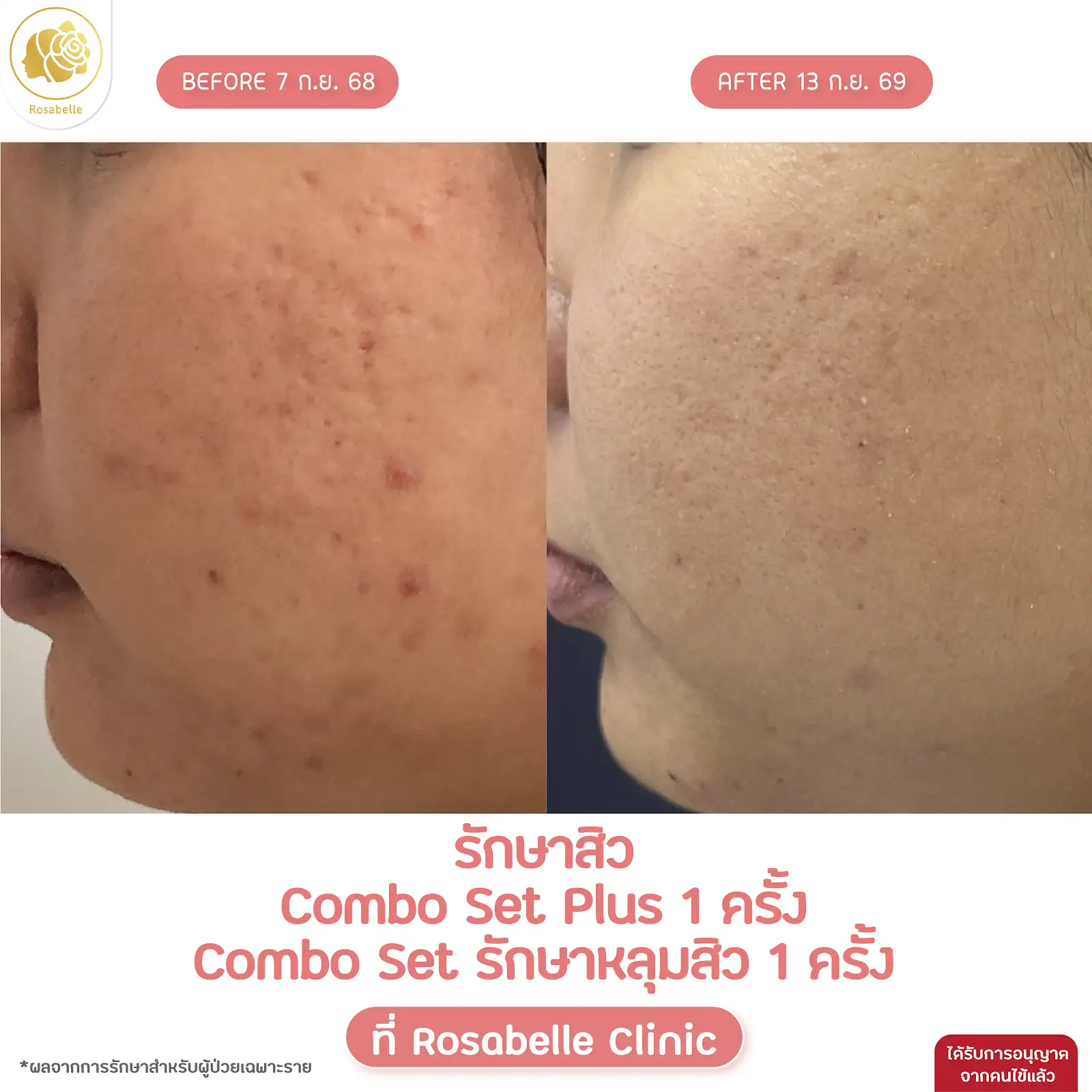 รีวิวดูแลสิวร่วมกับโปรแกรม Combo Set และ Plus+ — ภาพการรักษาหลายโปรแกรมร่วมกัน ตามรายละเอียดในภาพ
