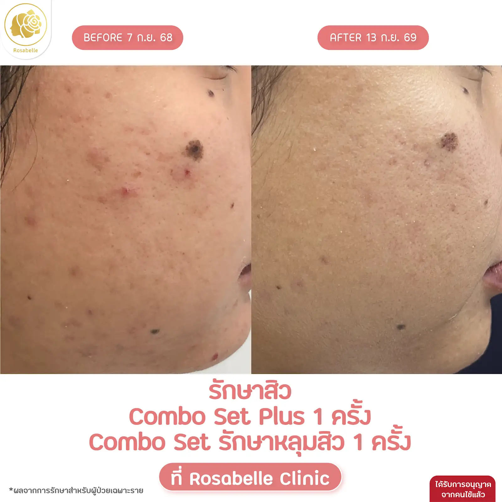 รีวิวดูแลสิวร่วมกับโปรแกรม Combo Set และ Plus+ — ภาพการรักษาหลายโปรแกรมร่วมกัน ตามรายละเอียดในภาพ