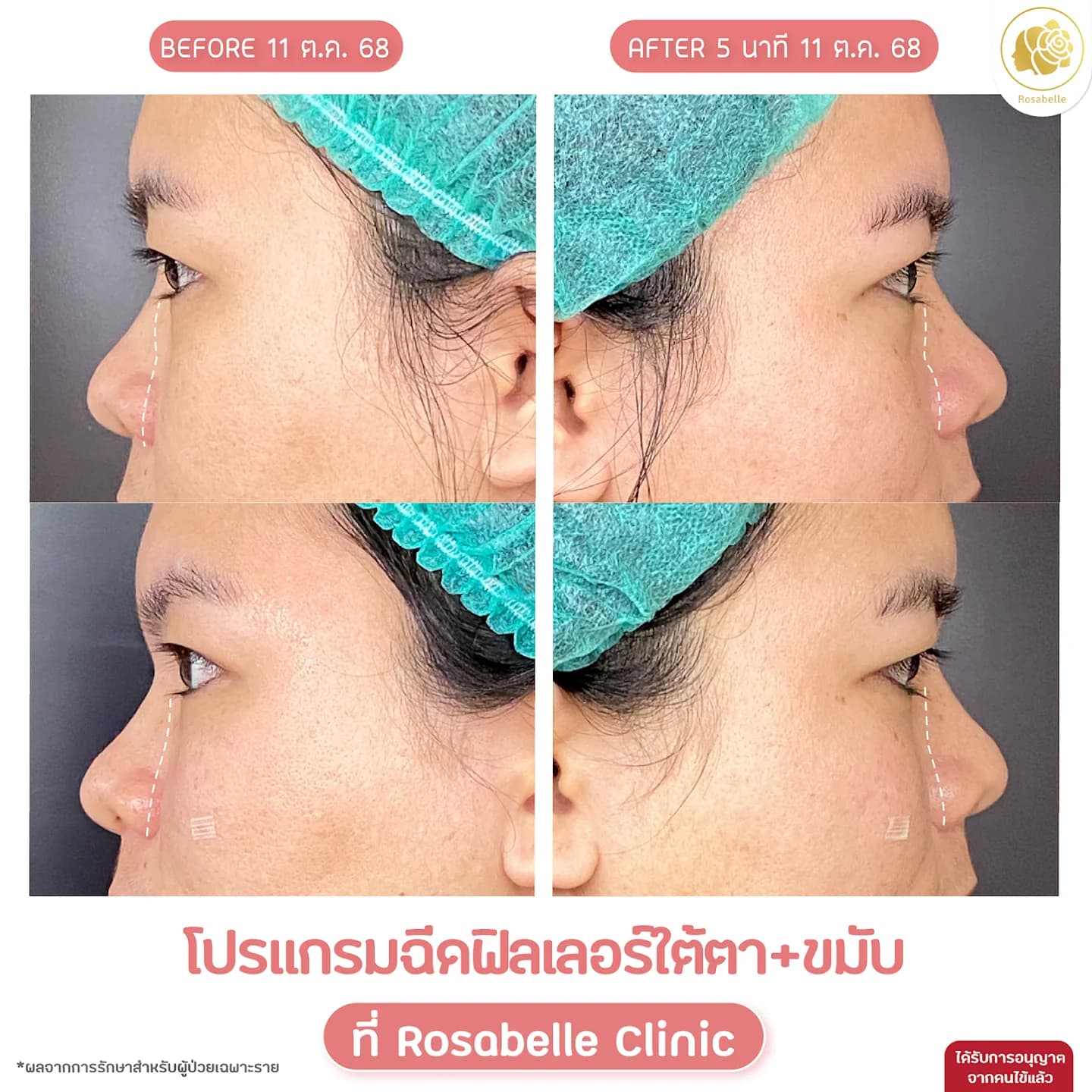 รีวิวโปรแกรมฟิลเลอร์ใต้ตาและขมับ — ภาพหลังทำ 5 นาที แสดงสภาพในช่วงเวลานั้น