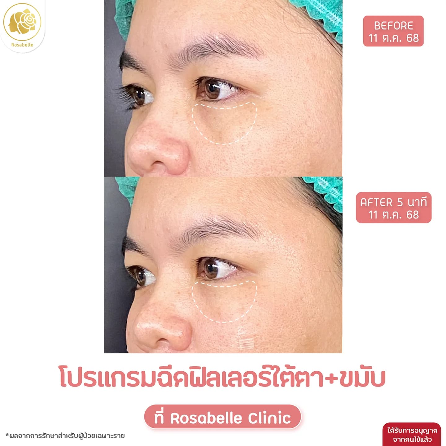 รีวิวโปรแกรมฟิลเลอร์ใต้ตาและขมับ — ภาพหลังทำ 5 นาที แสดงสภาพในช่วงเวลานั้น
