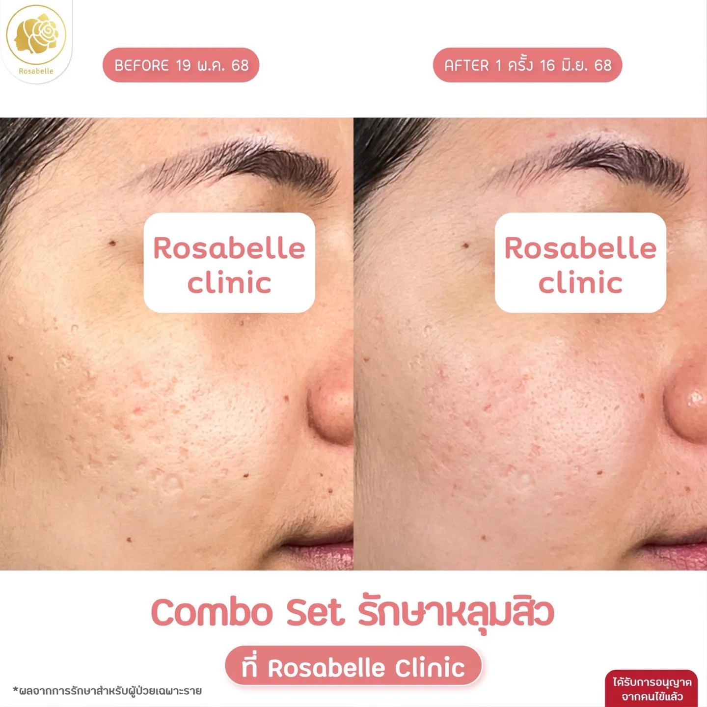 รีวิวโปรแกรม Combo Set