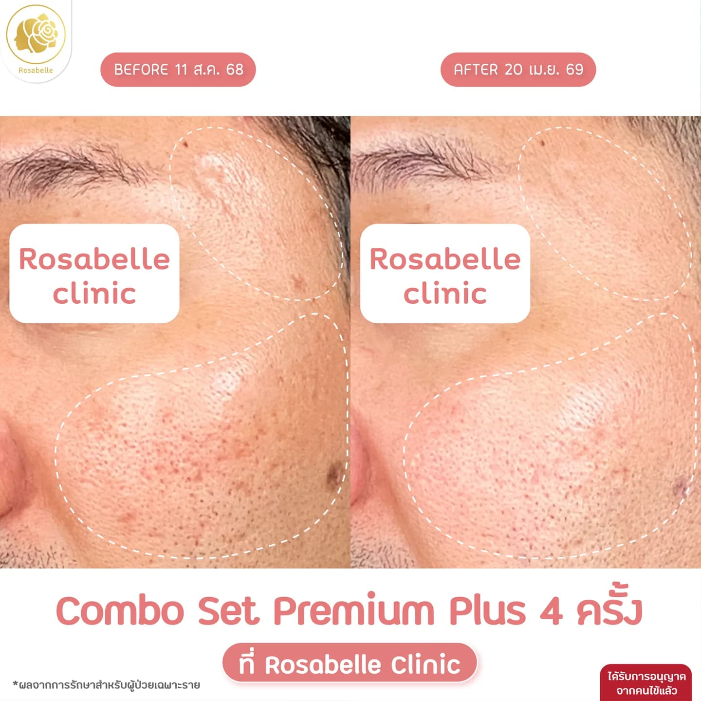รีวิวโปรแกรม Combo Set Premium Plus+
