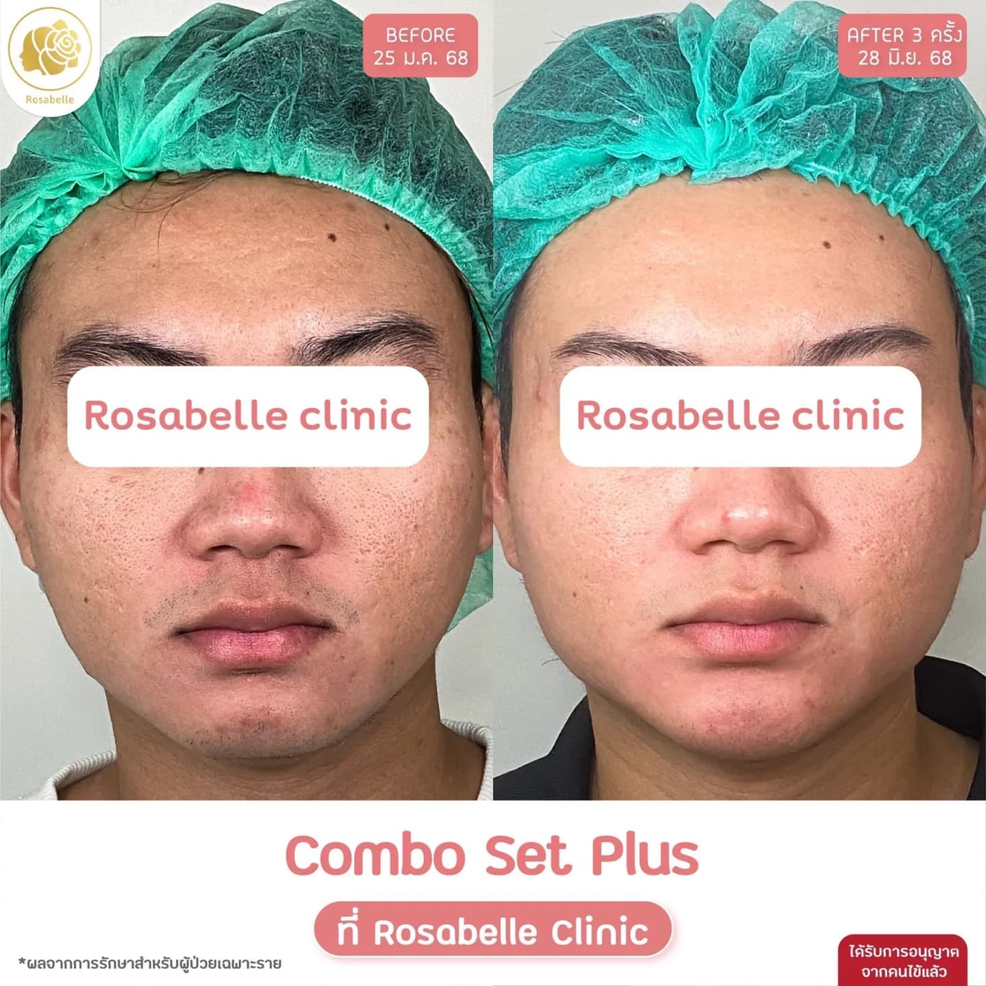 รีวิวโปรแกรม Combo Set Plus+