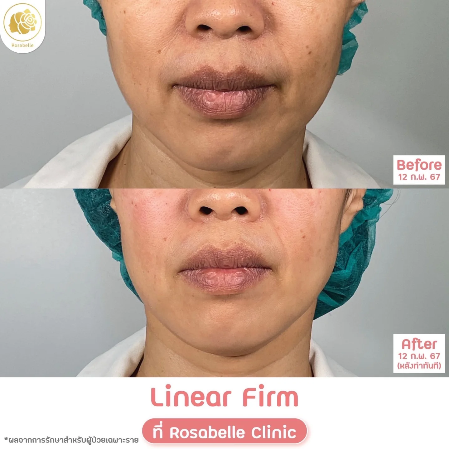 รีวิวโปรแกรม Linear HIFU