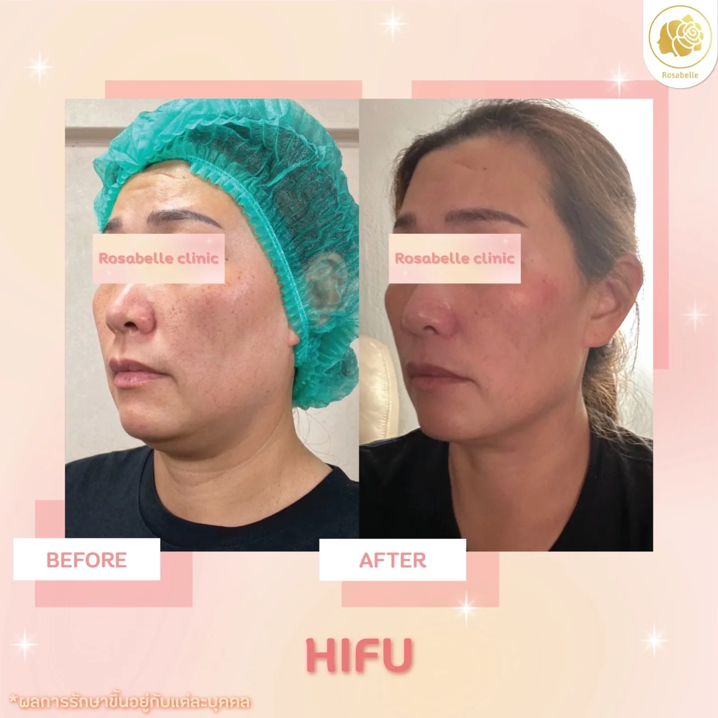 รีวิวโปรแกรมยกกระชับด้วยอัลตราซาวด์ — ดูช่วงเวลาและจำนวนครั้งที่ระบุในภาพ