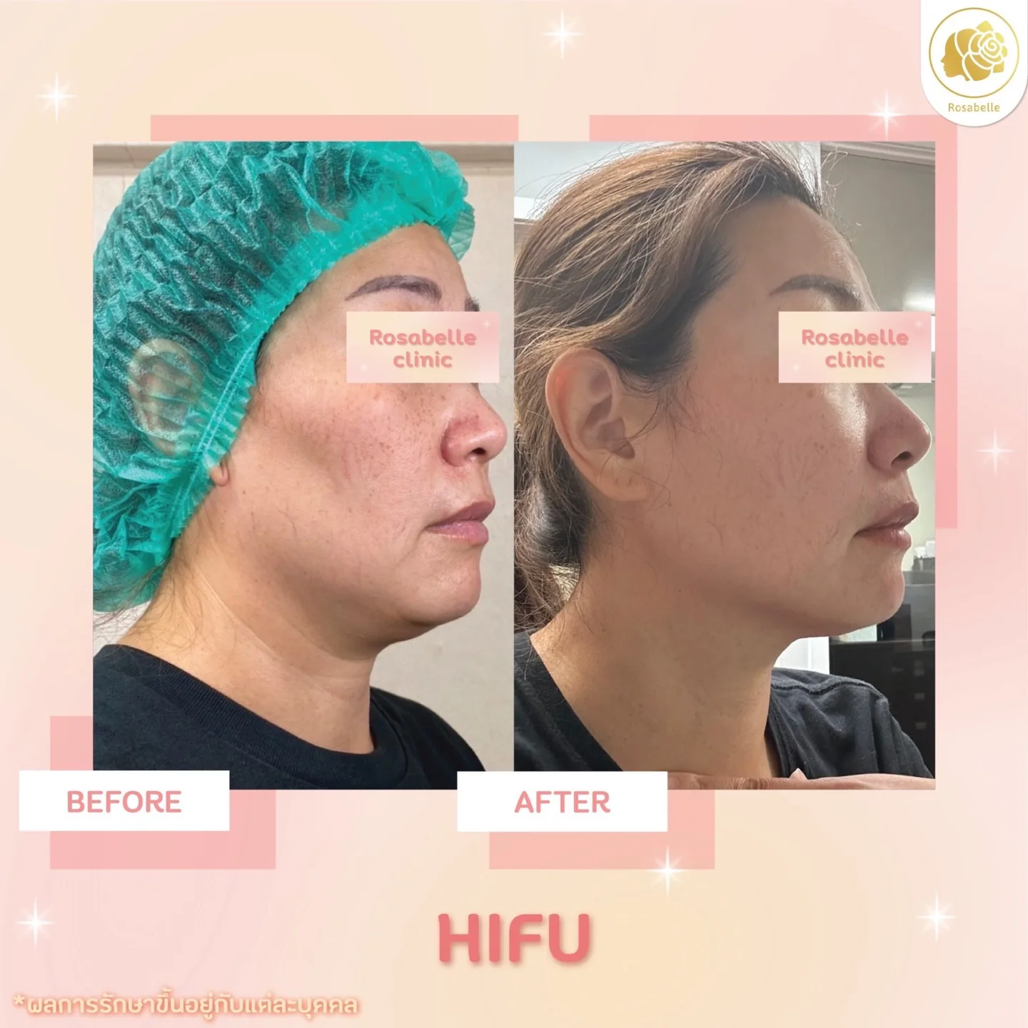 รีวิวโปรแกรมยกกระชับด้วยอัลตราซาวด์ — ดูช่วงเวลาและจำนวนครั้งที่ระบุในภาพ
