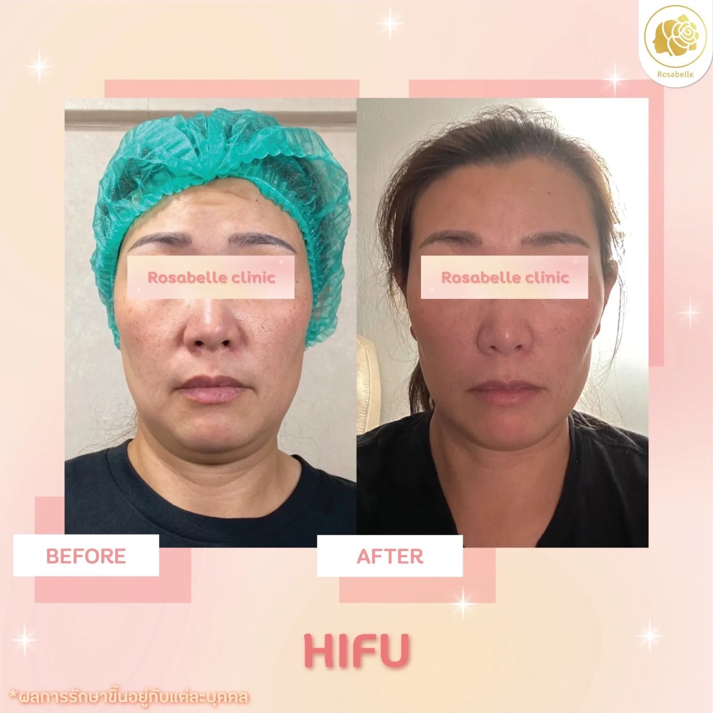 รีวิวโปรแกรมยกกระชับด้วยอัลตราซาวด์ — ดูช่วงเวลาและจำนวนครั้งที่ระบุในภาพ