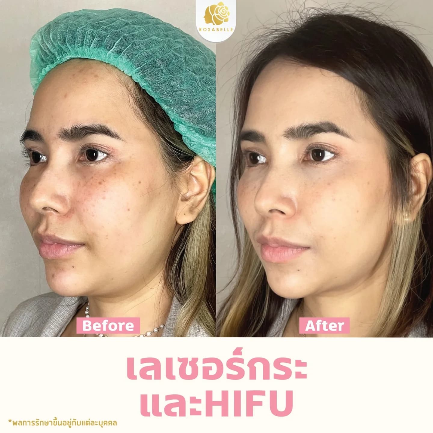 รีวิวโปรแกรมเลเซอร์ร่วมกับยกกระชับ — เป็นภาพการรักษาร่วมหลายวิธี