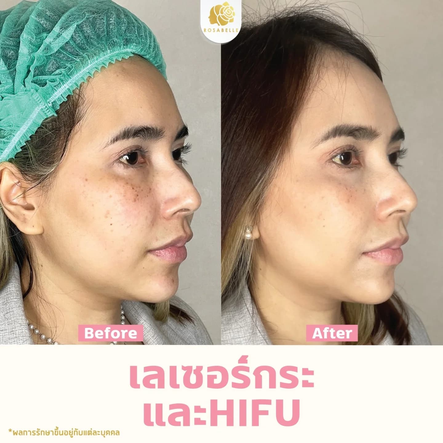 รีวิวโปรแกรมเลเซอร์ร่วมกับยกกระชับ — เป็นภาพการรักษาร่วมหลายวิธี