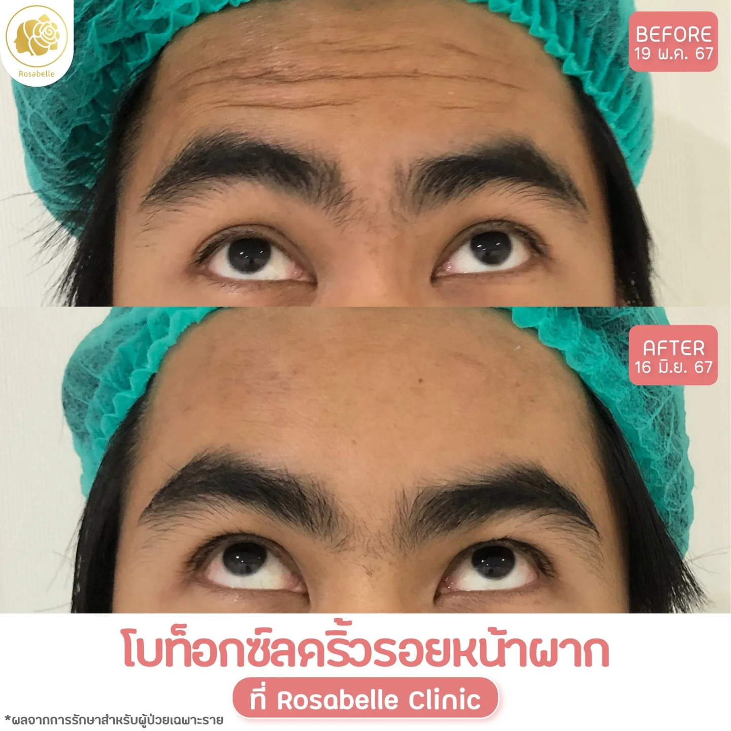 รีวิวโปรแกรมโบท็อกซ์ดูแลริ้วรอยบริเวณหน้าผาก