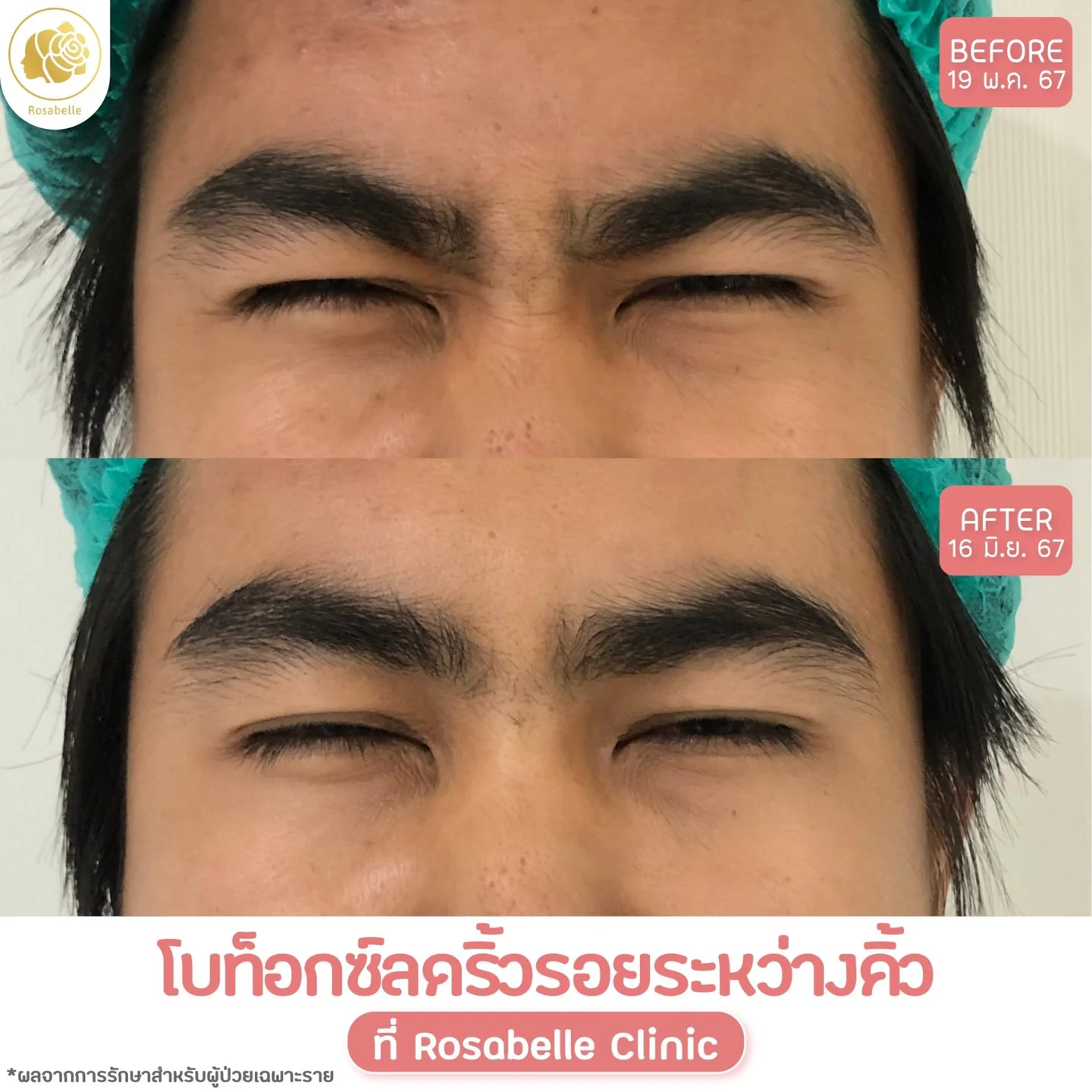 รีวิวโปรแกรมโบท็อกซ์ดูแลริ้วรอยบริเวณระหว่างคิ้ว — ภาพก่อนและหลังรับบริการ ตามวันที่และรายละเอียดที่ระบุในภาพ
