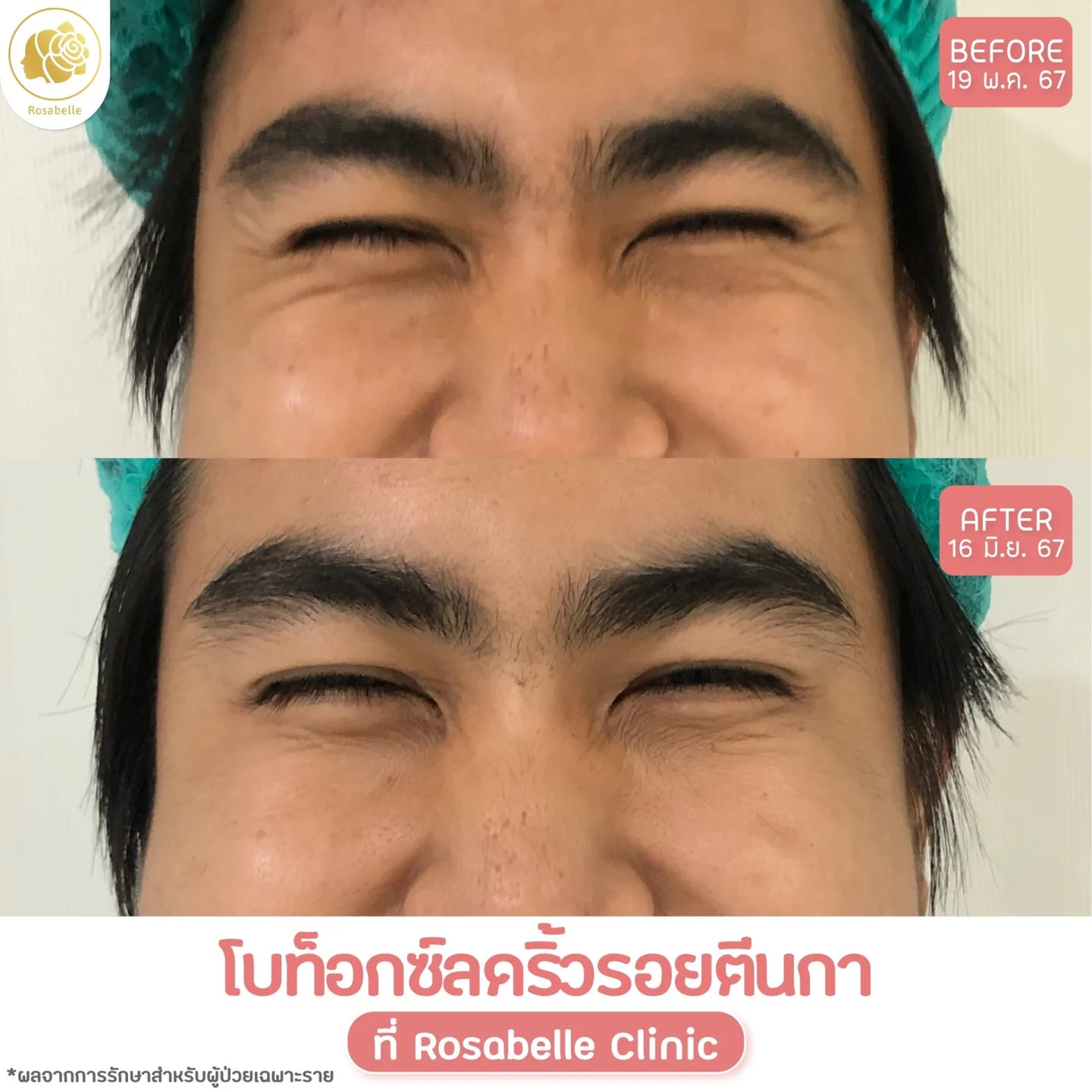 รีวิวโปรแกรมโบท็อกซ์ดูแลริ้วรอยบริเวณหางตา — ภาพก่อนและหลังรับบริการ ตามวันที่และรายละเอียดที่ระบุในภาพ