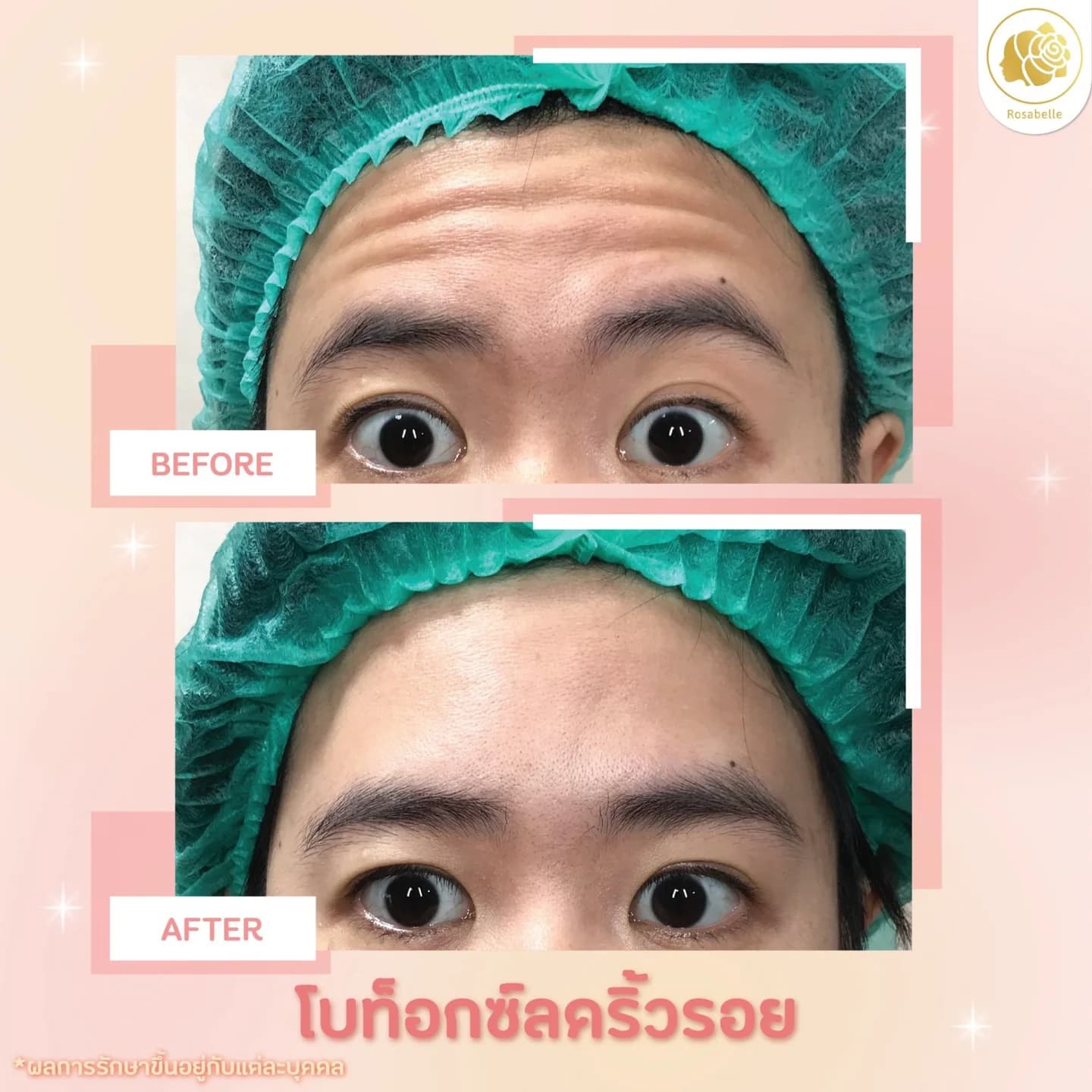 รีวิวโปรแกรมโบท็อกซ์ดูแลริ้วรอยบริเวณหน้าผาก — ภาพก่อนและหลังรับบริการ ตามวันที่และรายละเอียดที่ระบุในภาพ
