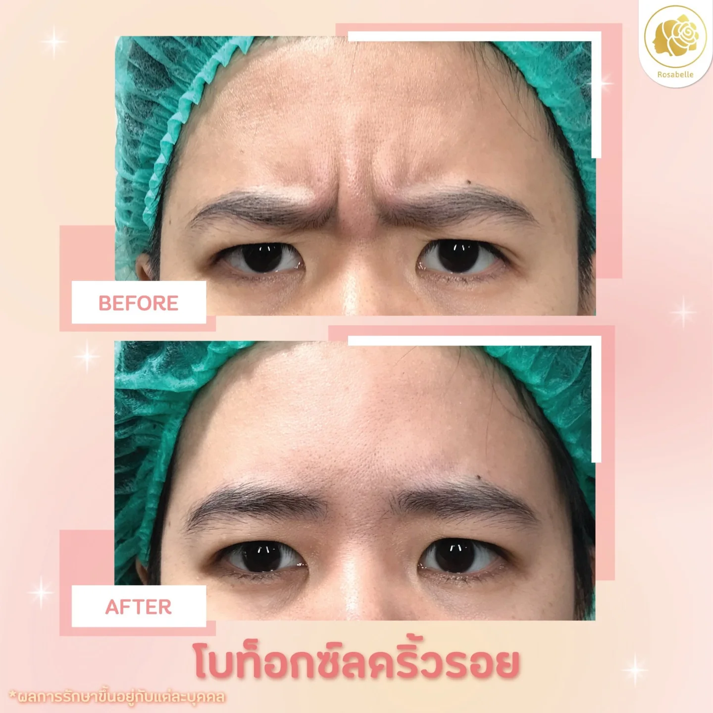 รีวิวโปรแกรมโบท็อกซ์ดูแลริ้วรอยบริเวณระหว่างคิ้ว — ภาพก่อนและหลังรับบริการ ตามวันที่และรายละเอียดที่ระบุในภาพ