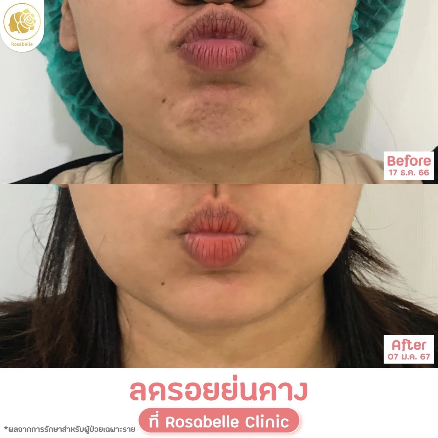 รีวิวโปรแกรมดูแลรอยย่นคาง