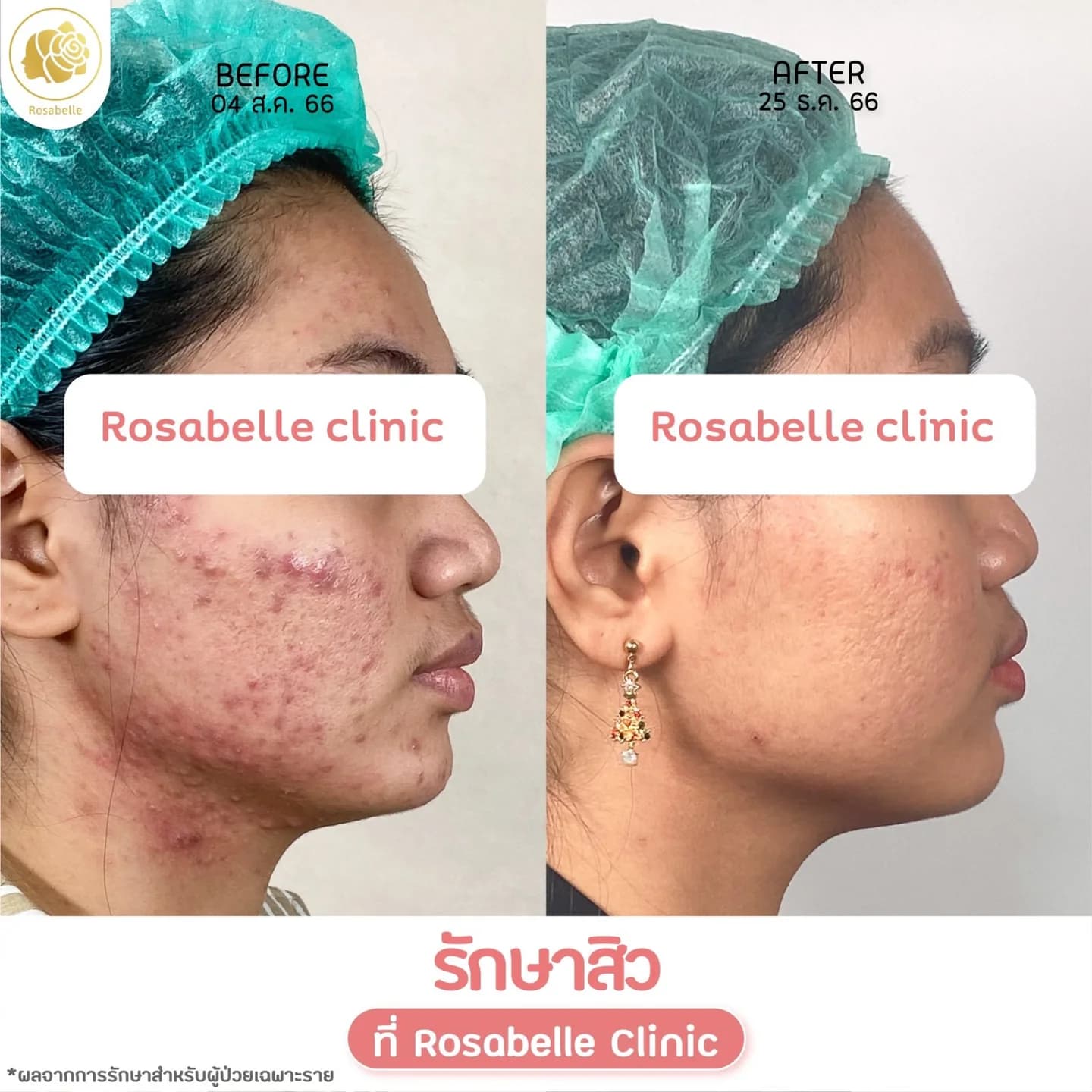 รีวิวโปรแกรมดูแลสิว