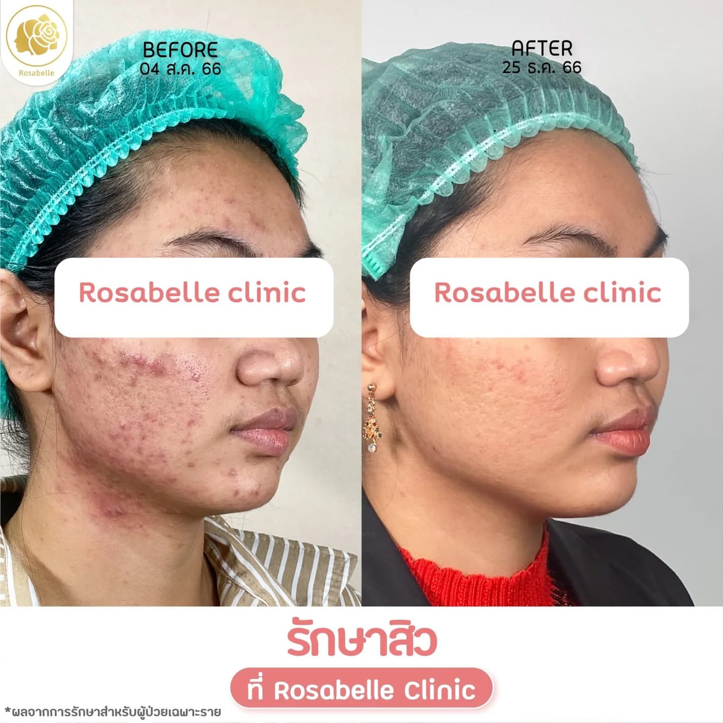 รีวิวโปรแกรมดูแลสิว — ดูช่วงเวลาและจำนวนครั้งที่ระบุในภาพ
