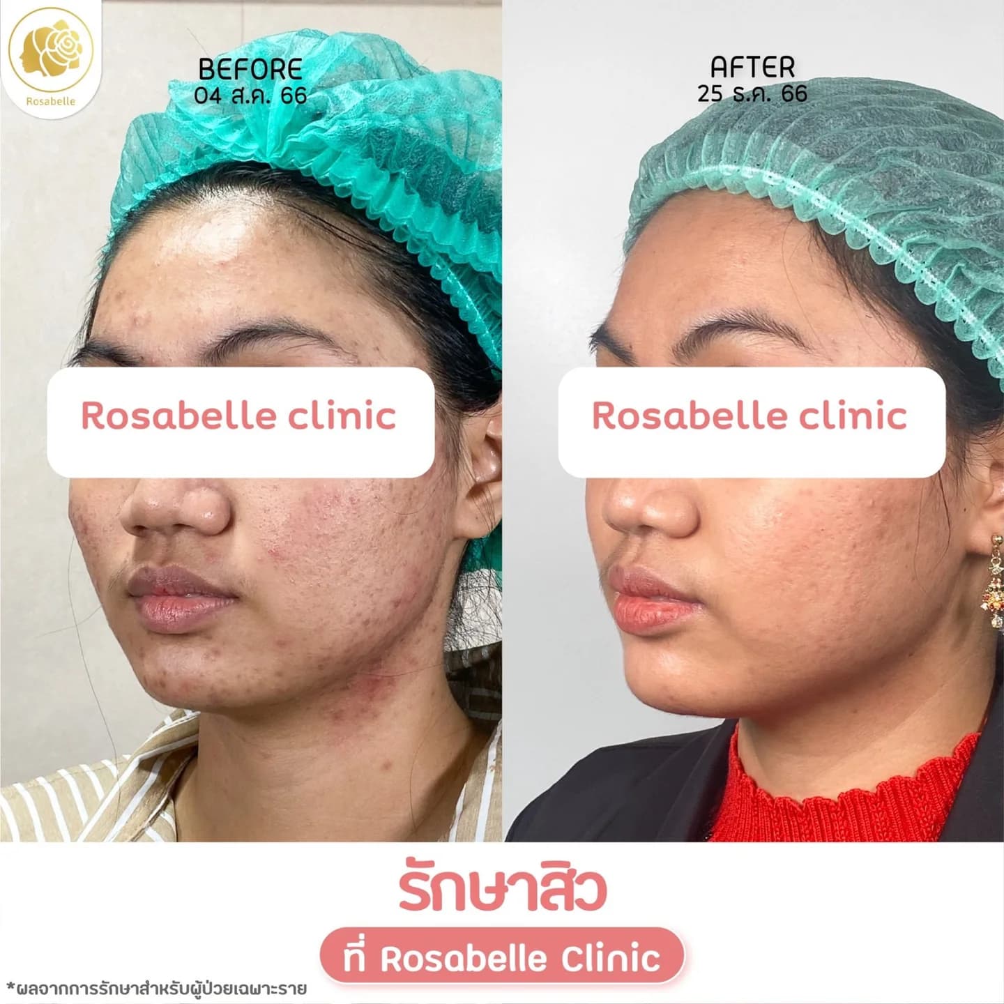 รีวิวโปรแกรมดูแลสิว — ดูช่วงเวลาและจำนวนครั้งที่ระบุในภาพ