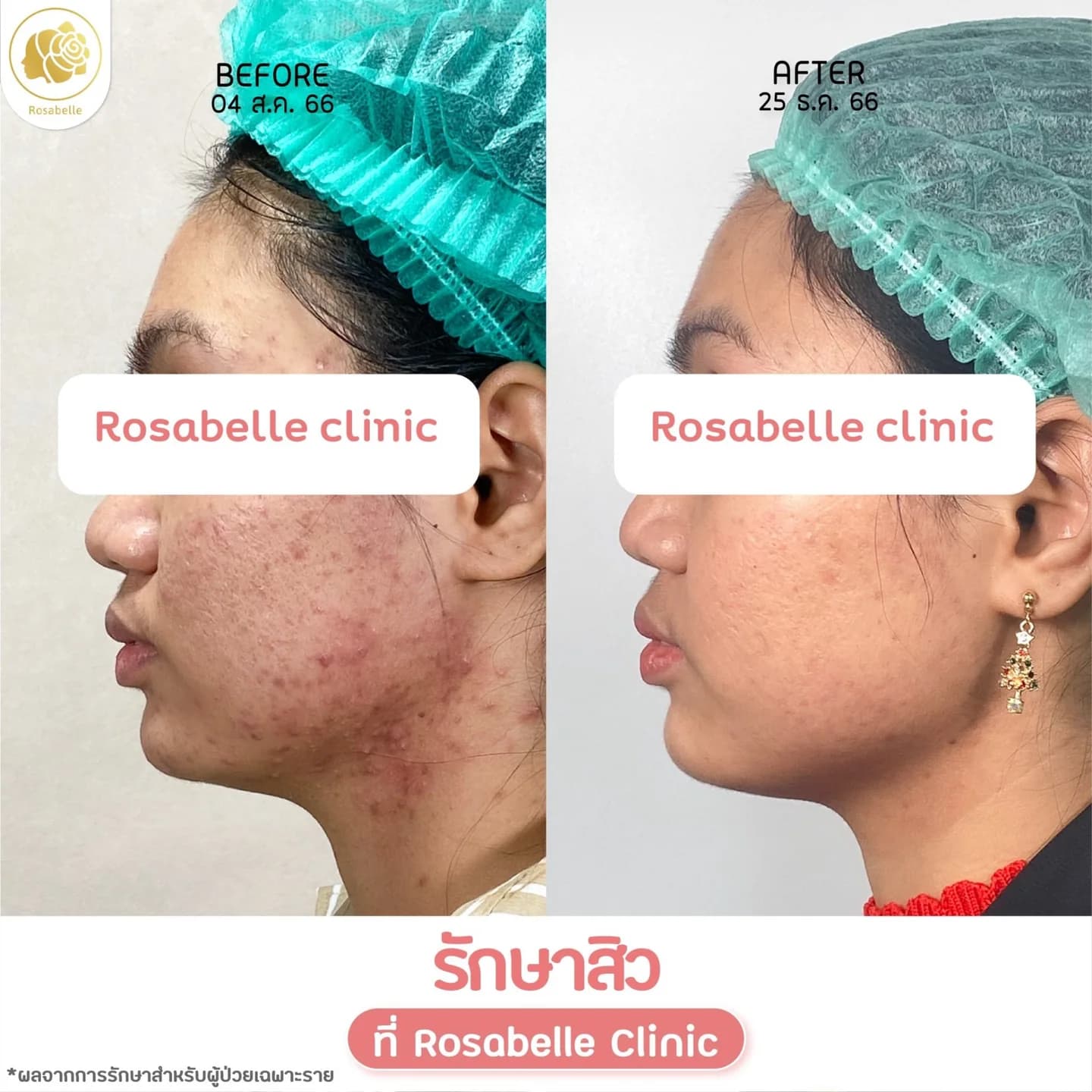 รีวิวโปรแกรมดูแลสิว — ดูช่วงเวลาและจำนวนครั้งที่ระบุในภาพ