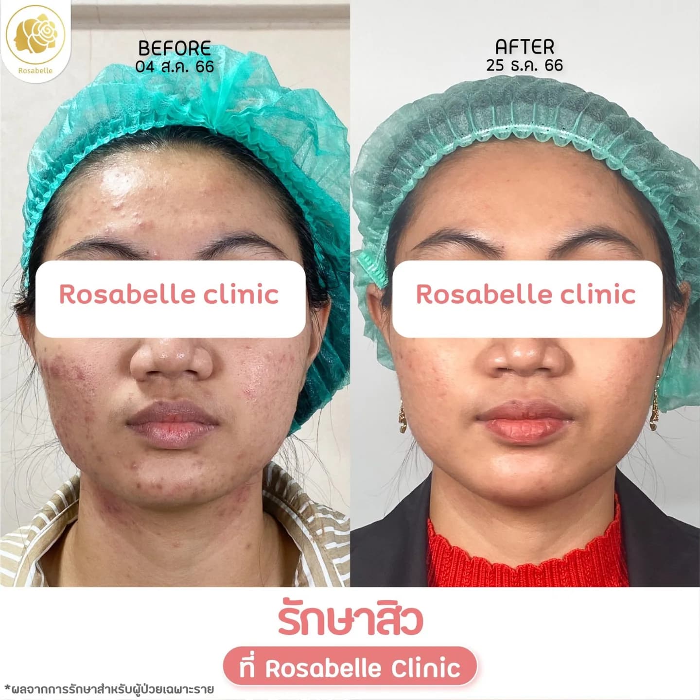รีวิวโปรแกรมดูแลสิว — ดูช่วงเวลาและจำนวนครั้งที่ระบุในภาพ
