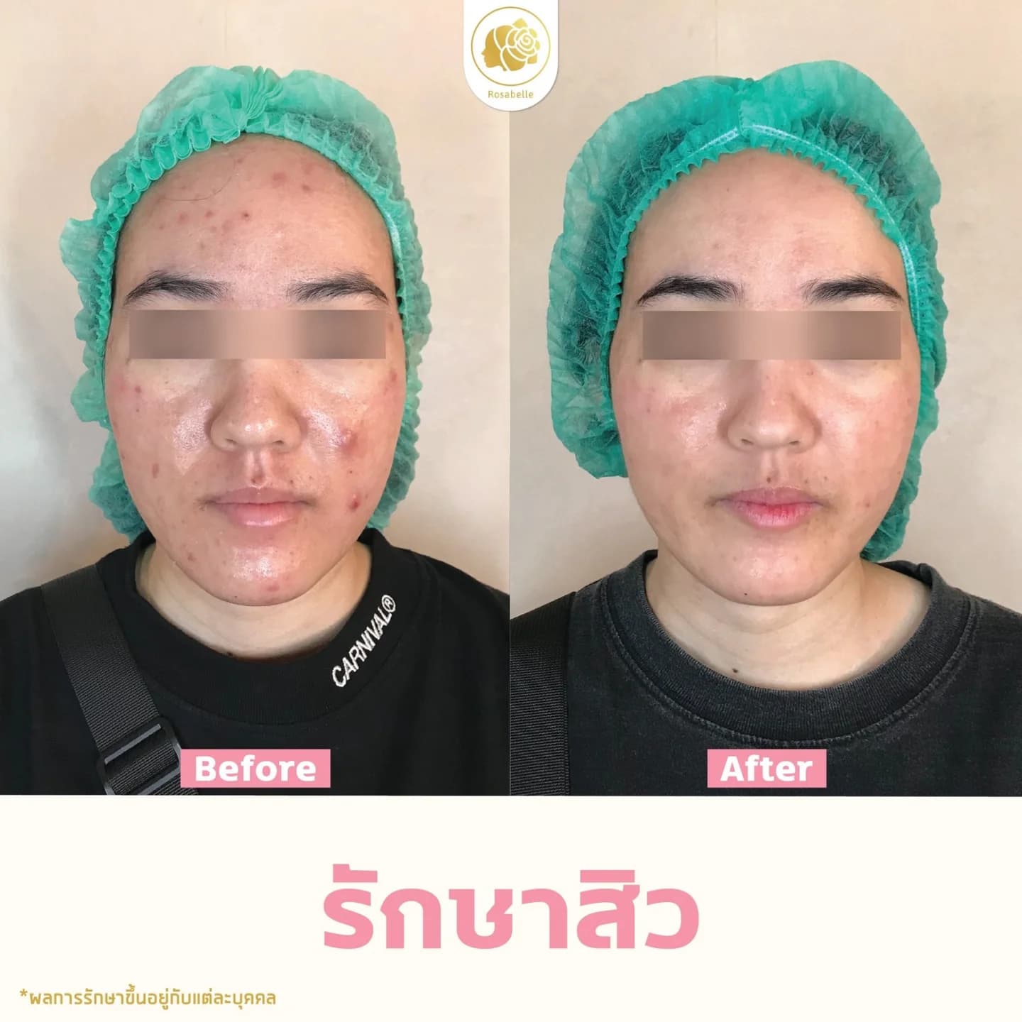 รีวิวโปรแกรมดูแลสิว — ดูช่วงเวลาและจำนวนครั้งที่ระบุในภาพ