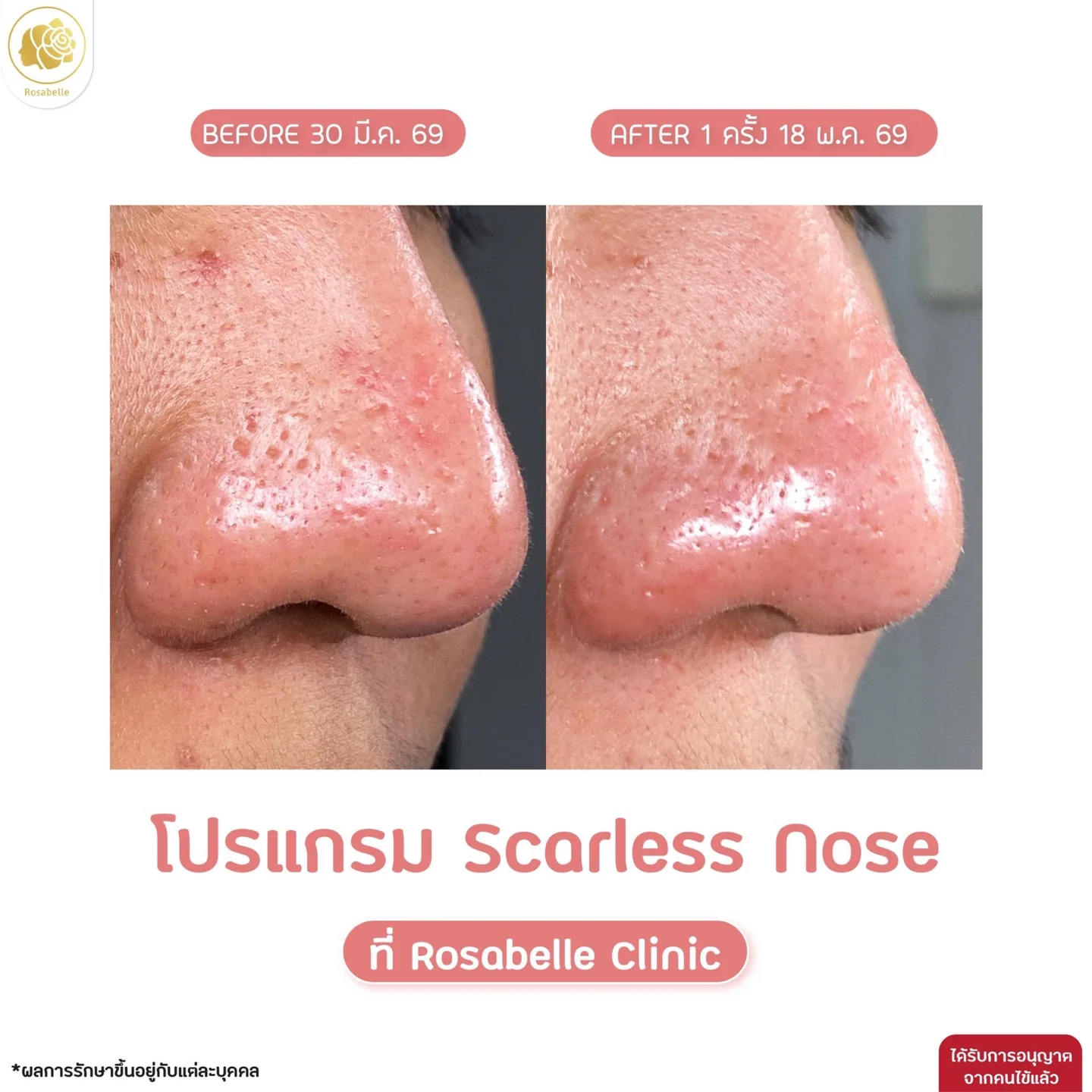 รีวิวโปรแกรม Scarless Nose — ดูช่วงเวลาและจำนวนครั้งที่ระบุในภาพ