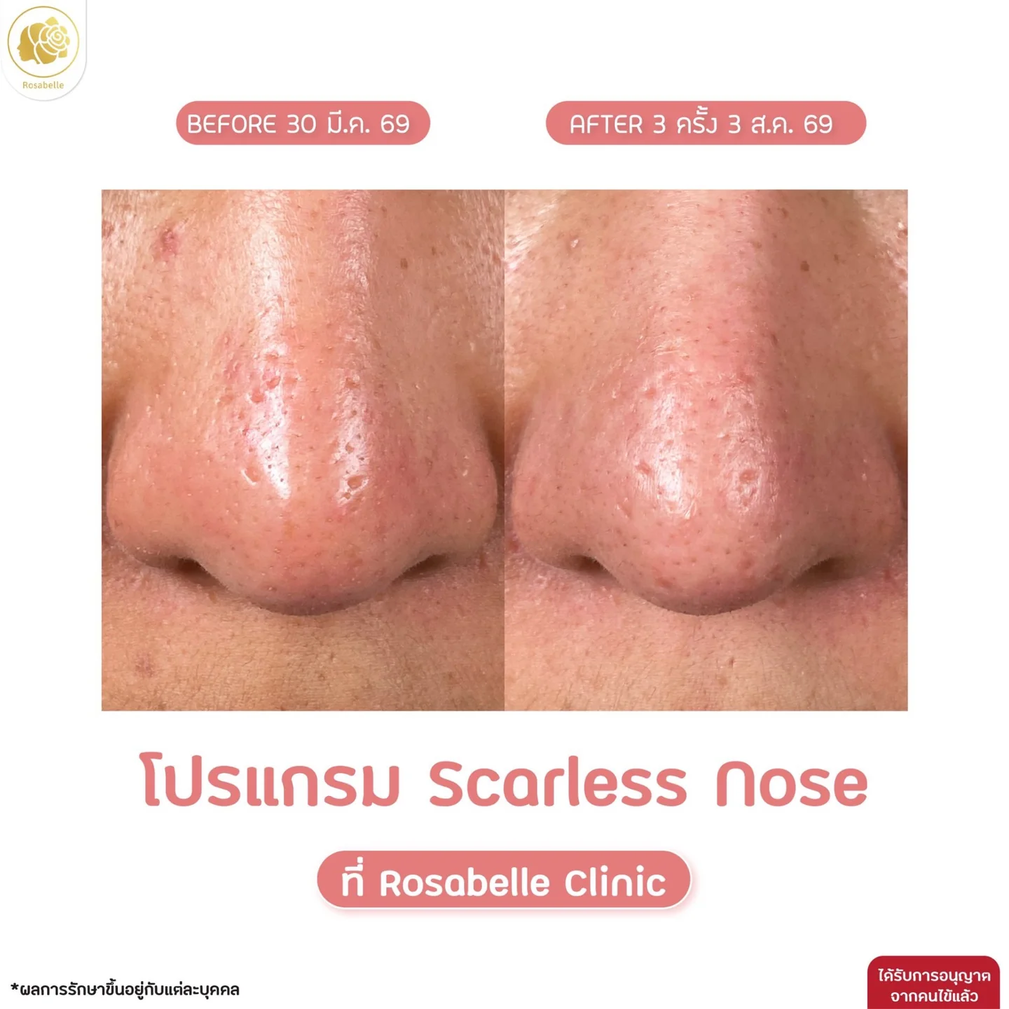 รีวิวโปรแกรม Scarless Nose ภาพที่ 2