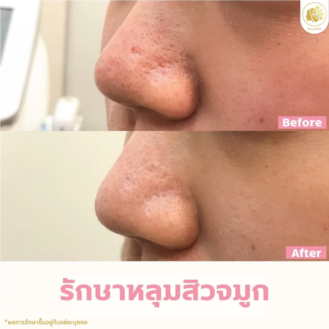 รีวิวหลุมสิวจมูก — ดูช่วงเวลาและจำนวนครั้งที่ระบุในภาพ