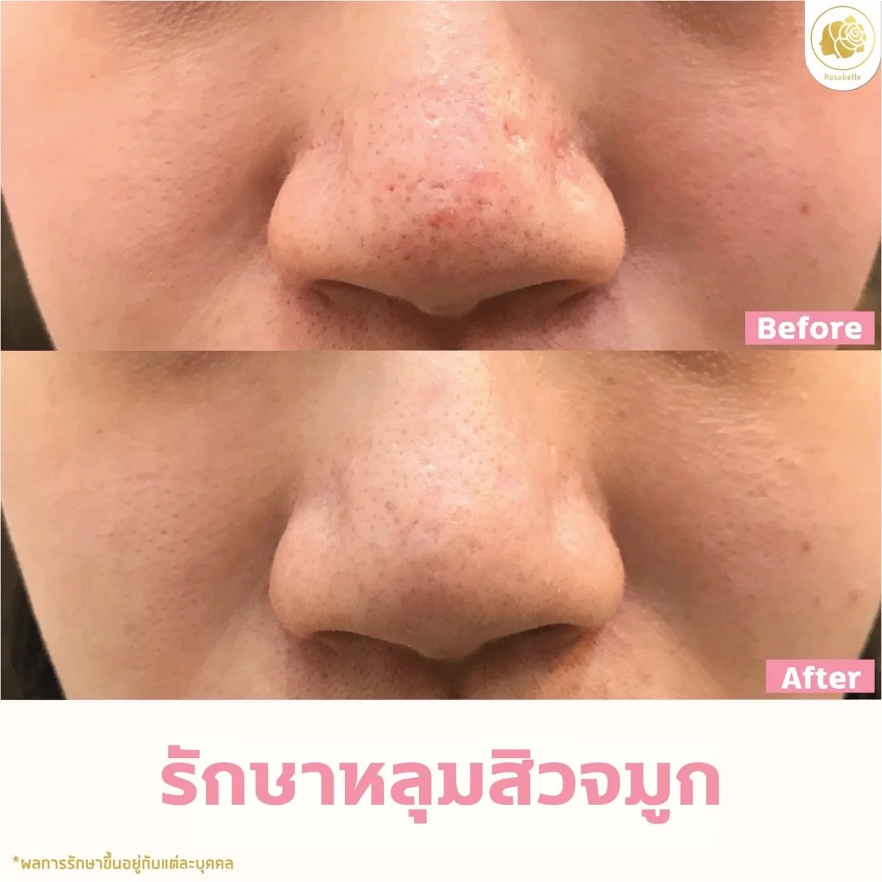 รีวิวหลุมสิวจมูก — ดูช่วงเวลาและจำนวนครั้งที่ระบุในภาพ