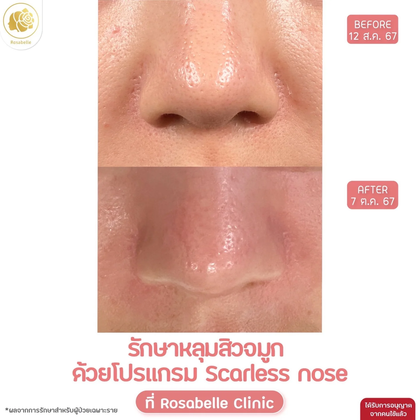 รีวิวโปรแกรม Scarless Nose ภาพที่ 3