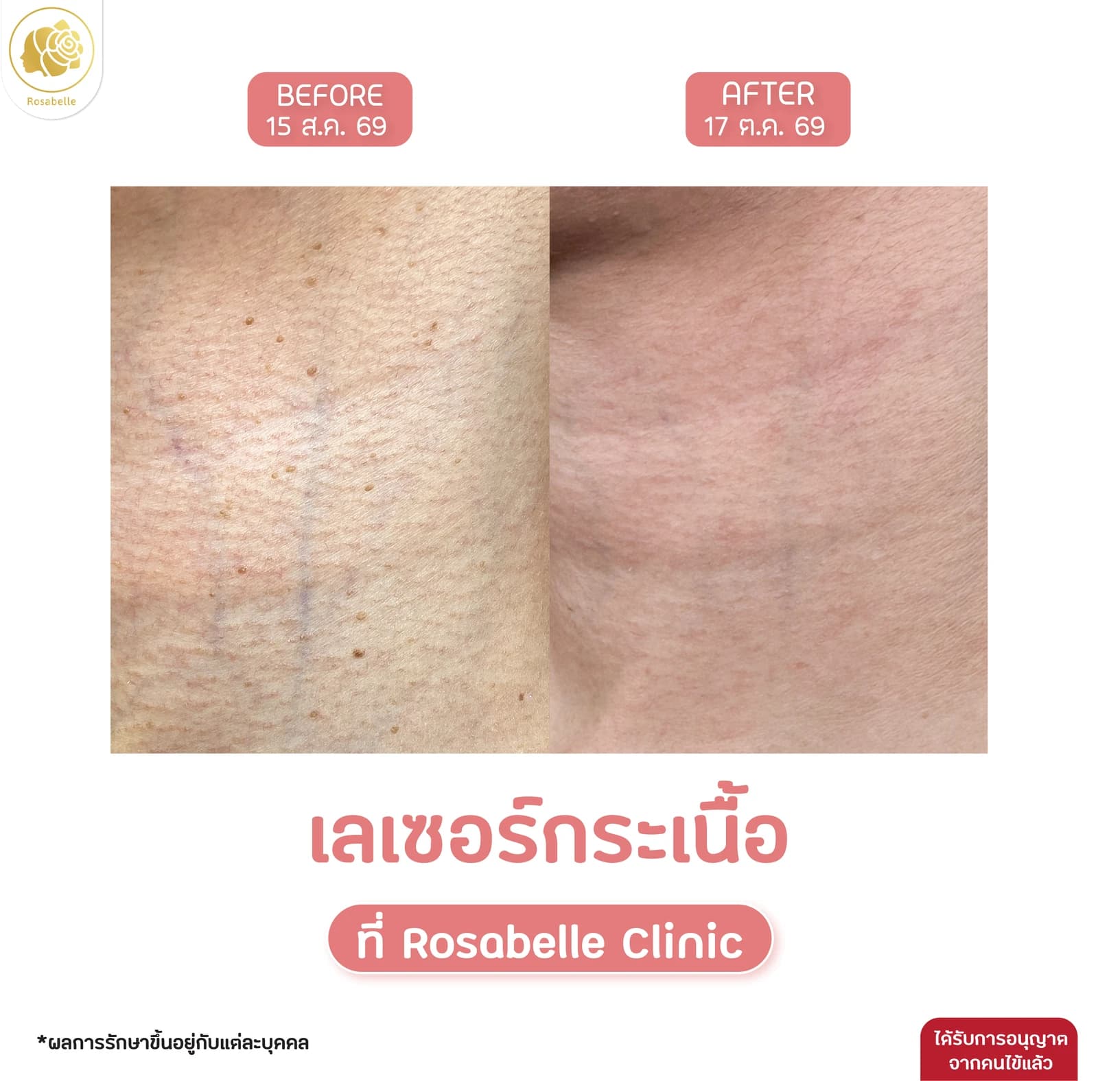 รีวิวเลเซอร์จี้กระเนื้อบริเวณคอ
