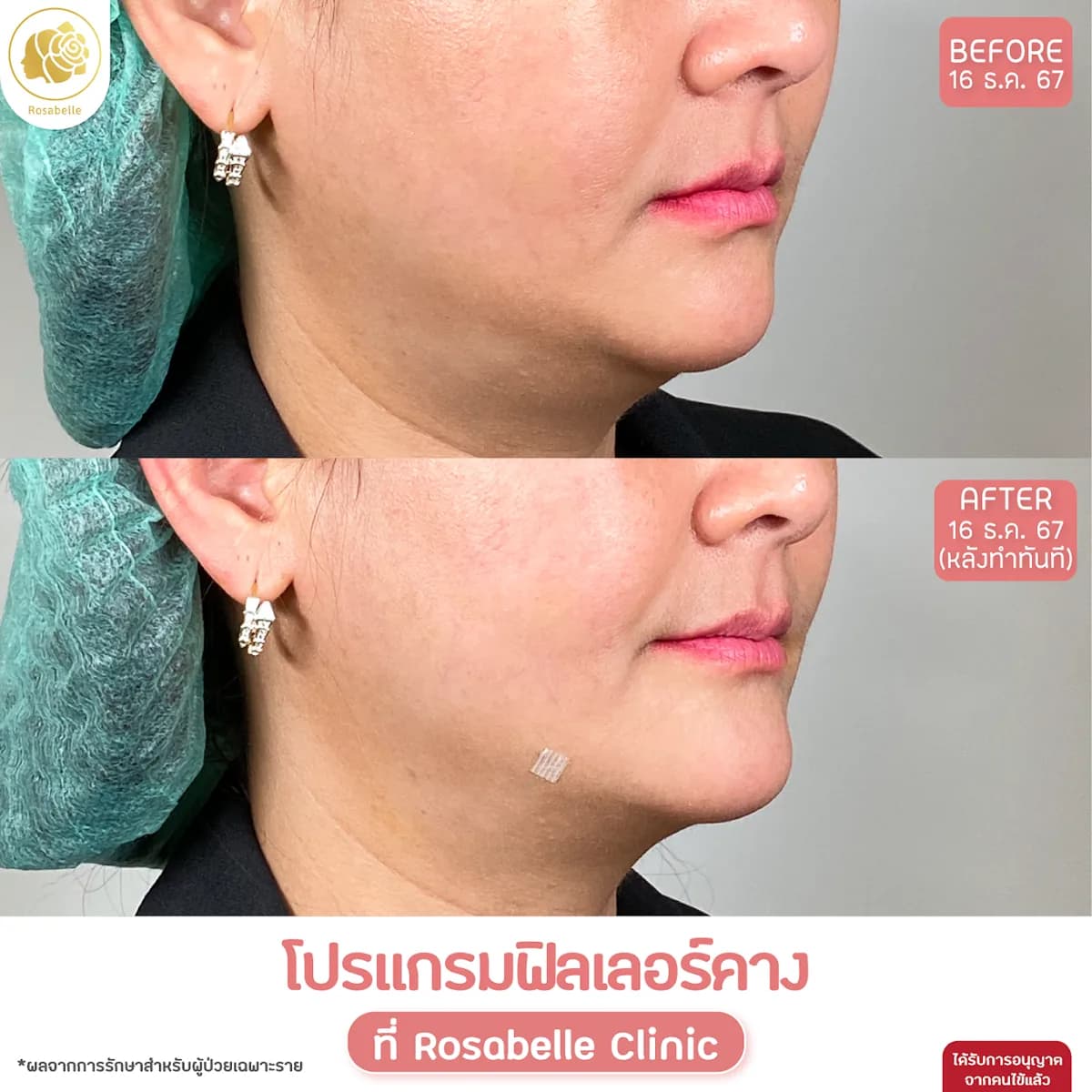 รีวิวโปรแกรมฟิลเลอร์คาง — ภาพก่อนและหลังทำทันที ตามวันที่ในภาพ