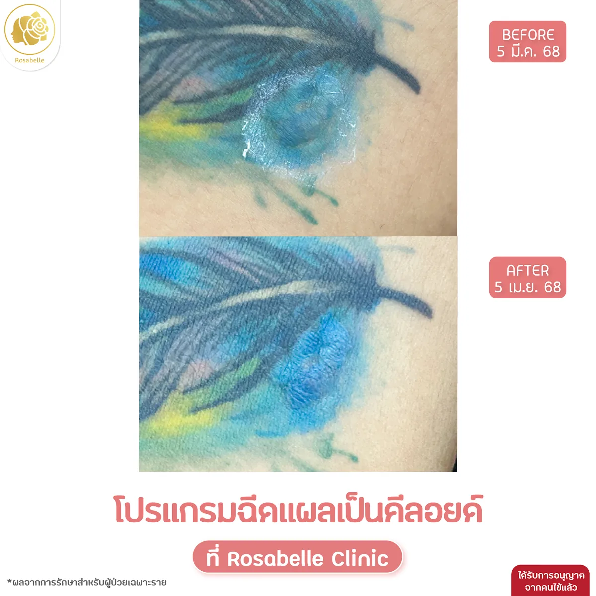 รีวิวโปรแกรมฉีดแผลเป็นคีลอยด์