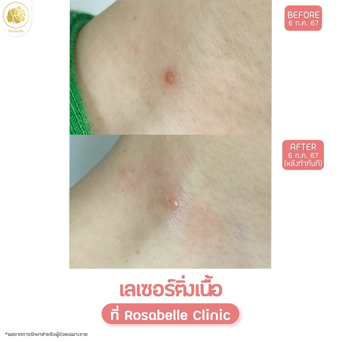 รีวิวโปรแกรมเลเซอร์จี้ติ่งเนื้อ