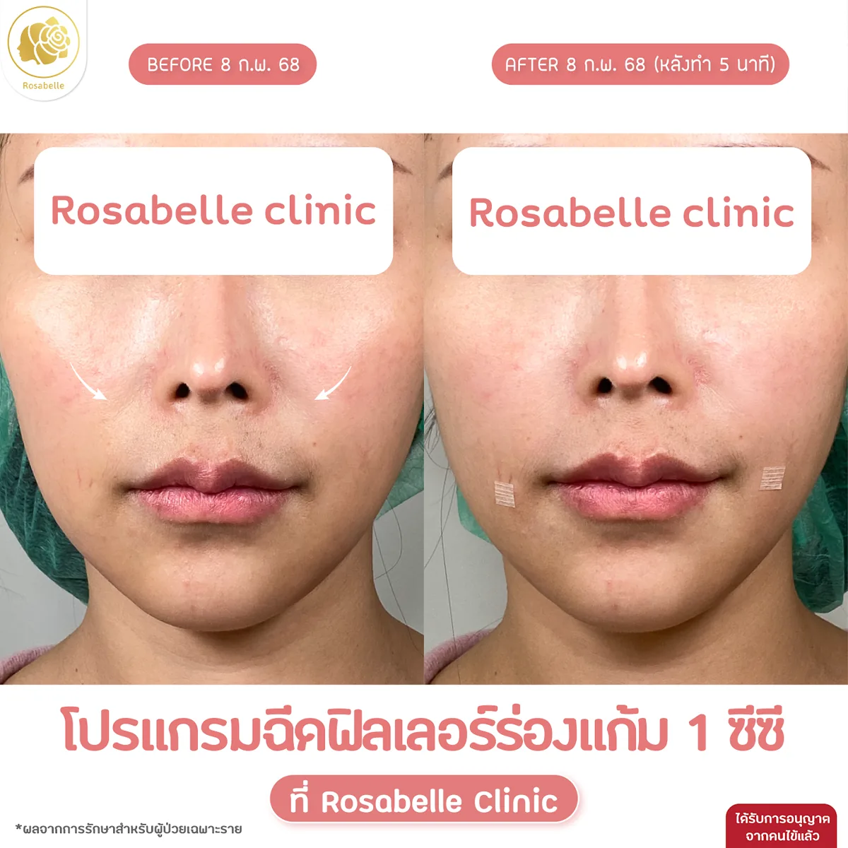 รีวิวโปรแกรมฟิลเลอร์ร่องแก้ม — ภาพก่อนและหลังทำ 5 นาที ตามวันที่ในภาพ