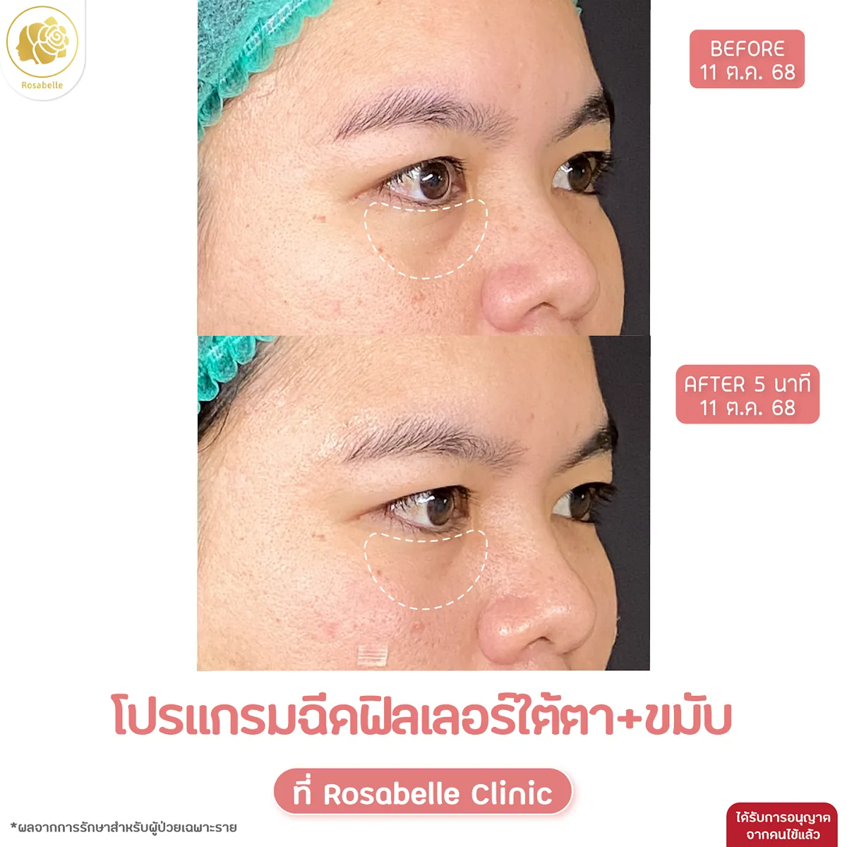 รีวิวโปรแกรมฟิลเลอร์ใต้ตาและขมับ — ภาพก่อนและหลังทำ 5 นาที ตามวันที่ในภาพ